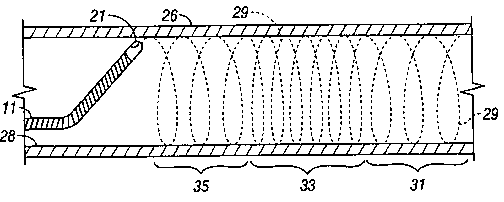 Device for sensing parameters of a hollow body organ