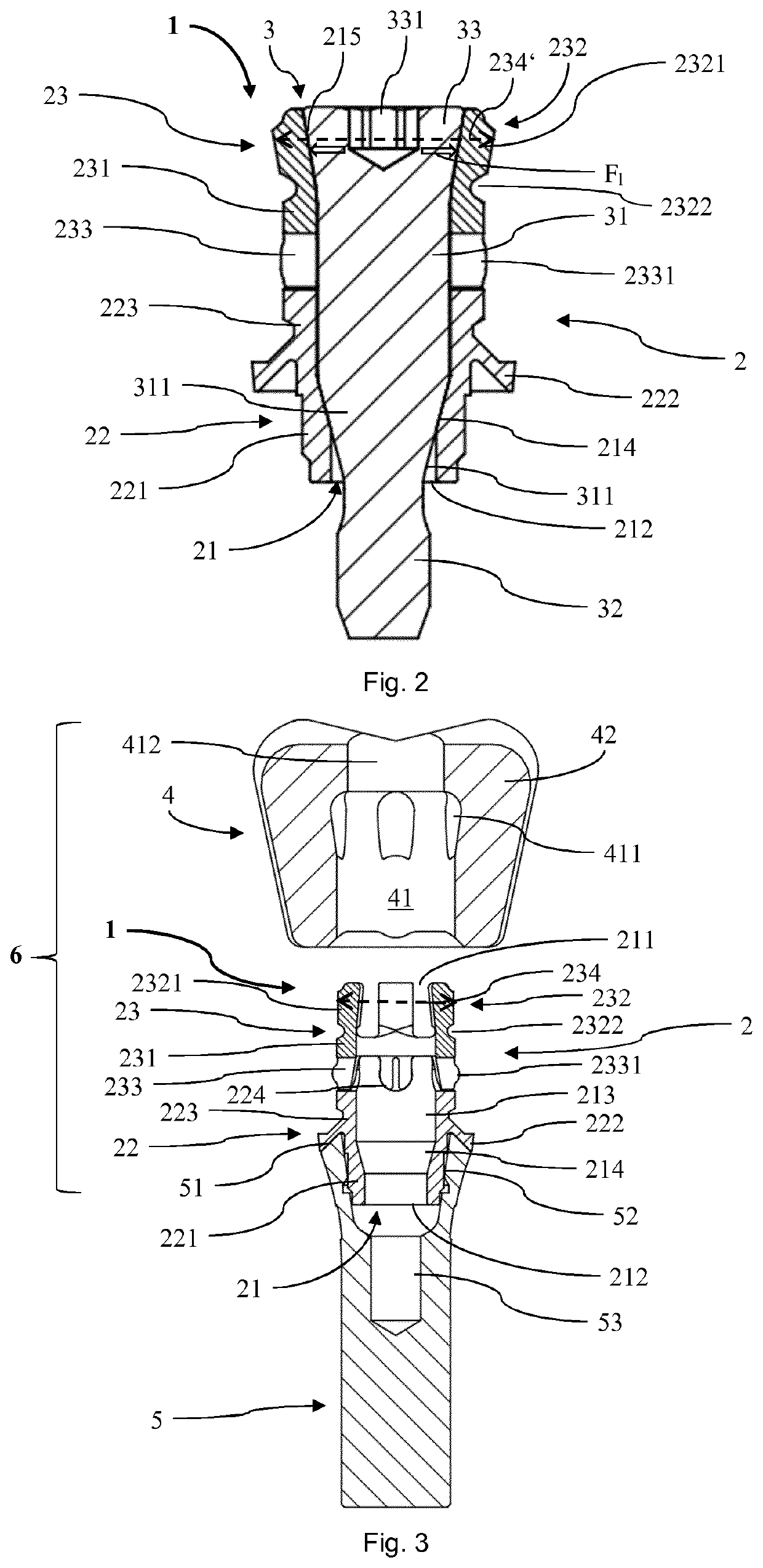 System for connecting a dental restoration to a dental implant