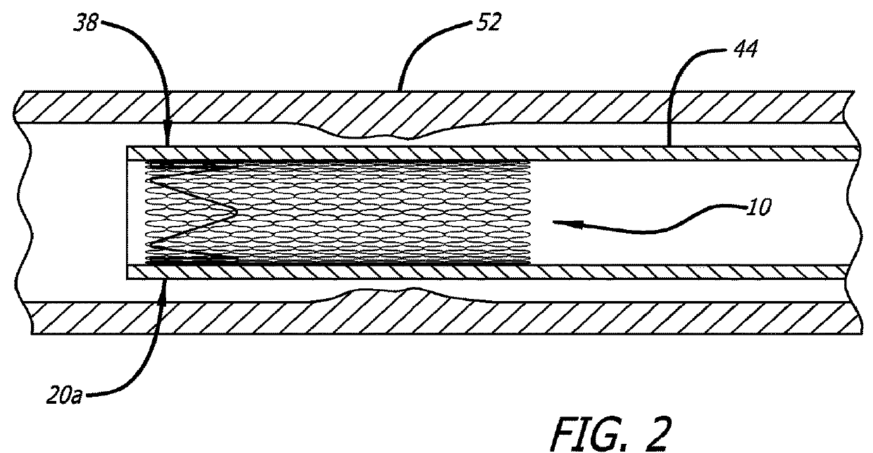 Braided stent with expansion ring and method of delivery