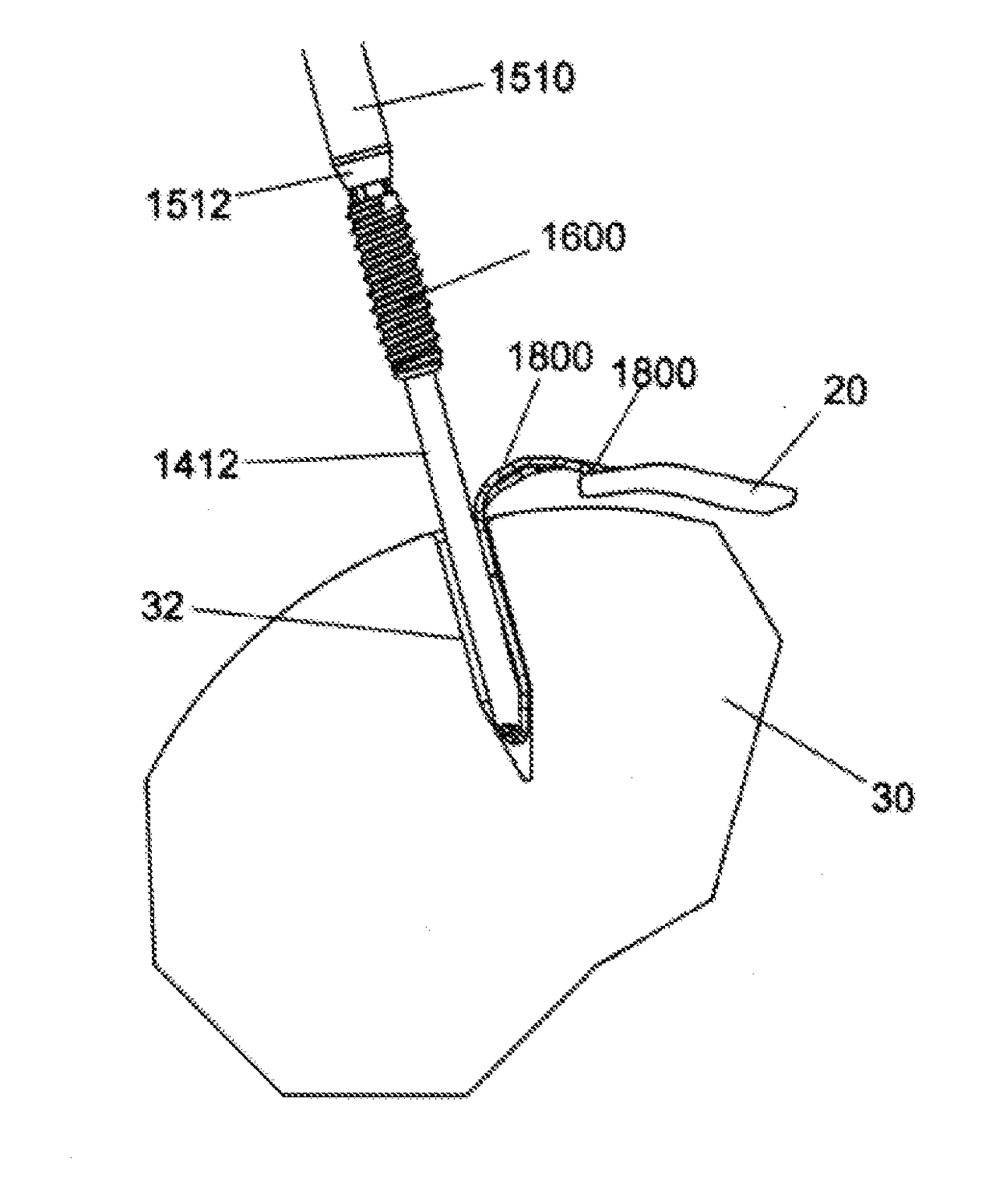 Implant placement systems, devices and methods