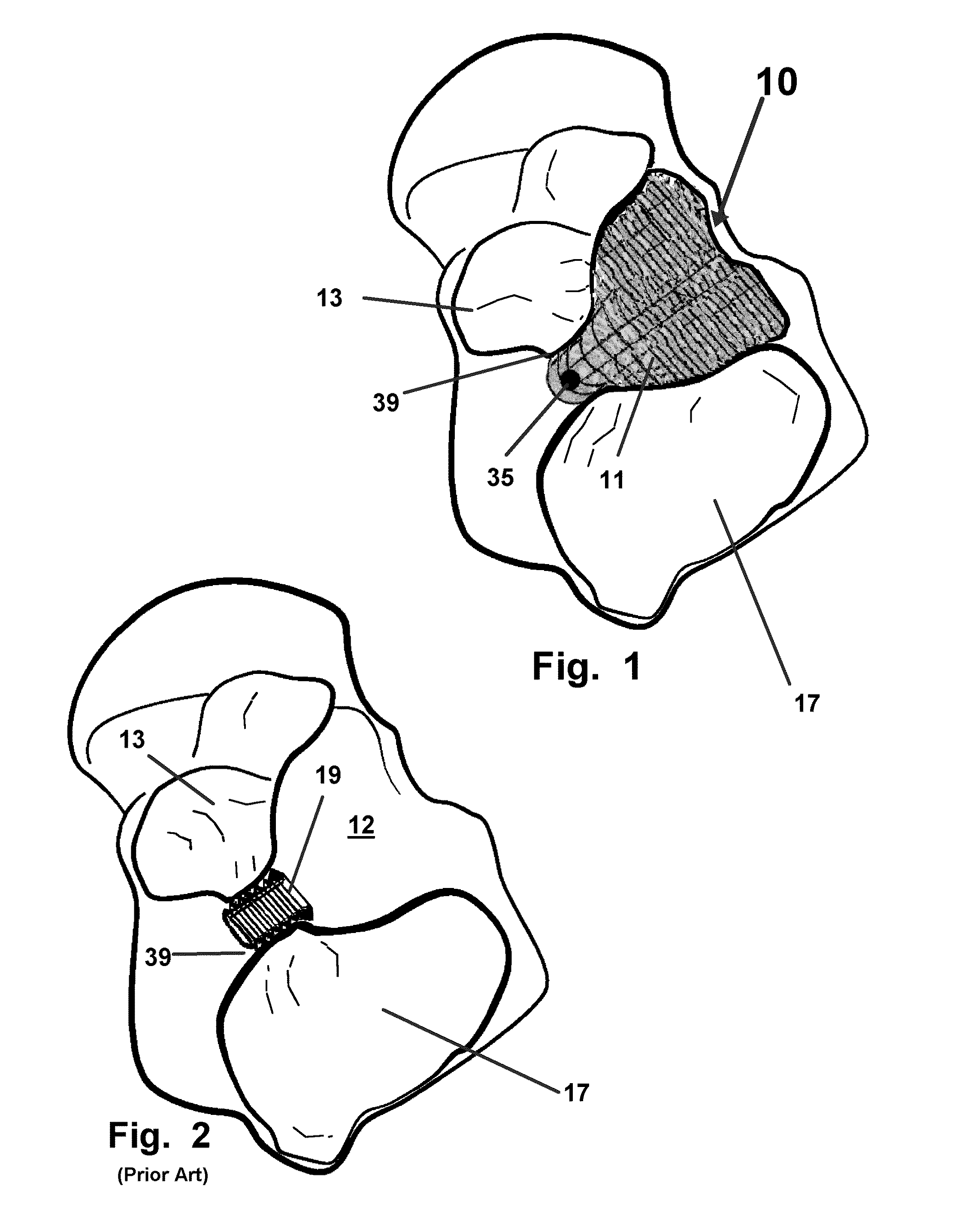 Subtalar arthroereisis implant apparatus and treatment method