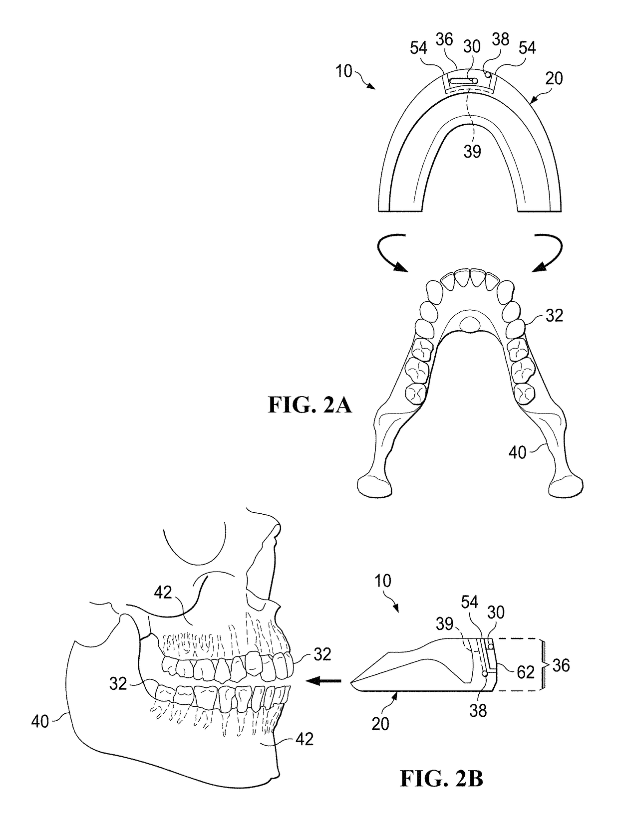 Orthodontic accelerator