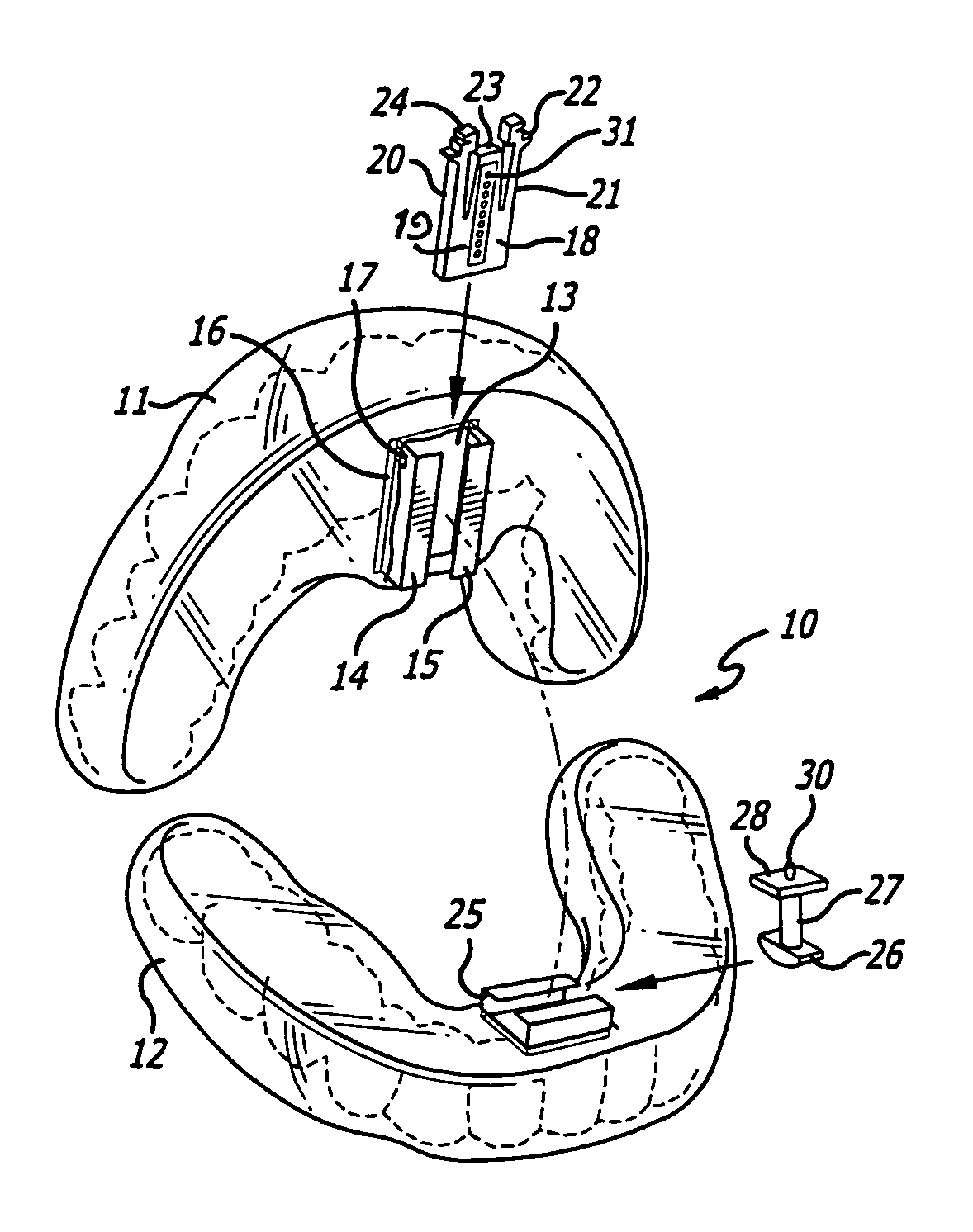Fixed therapeutic oral appliance