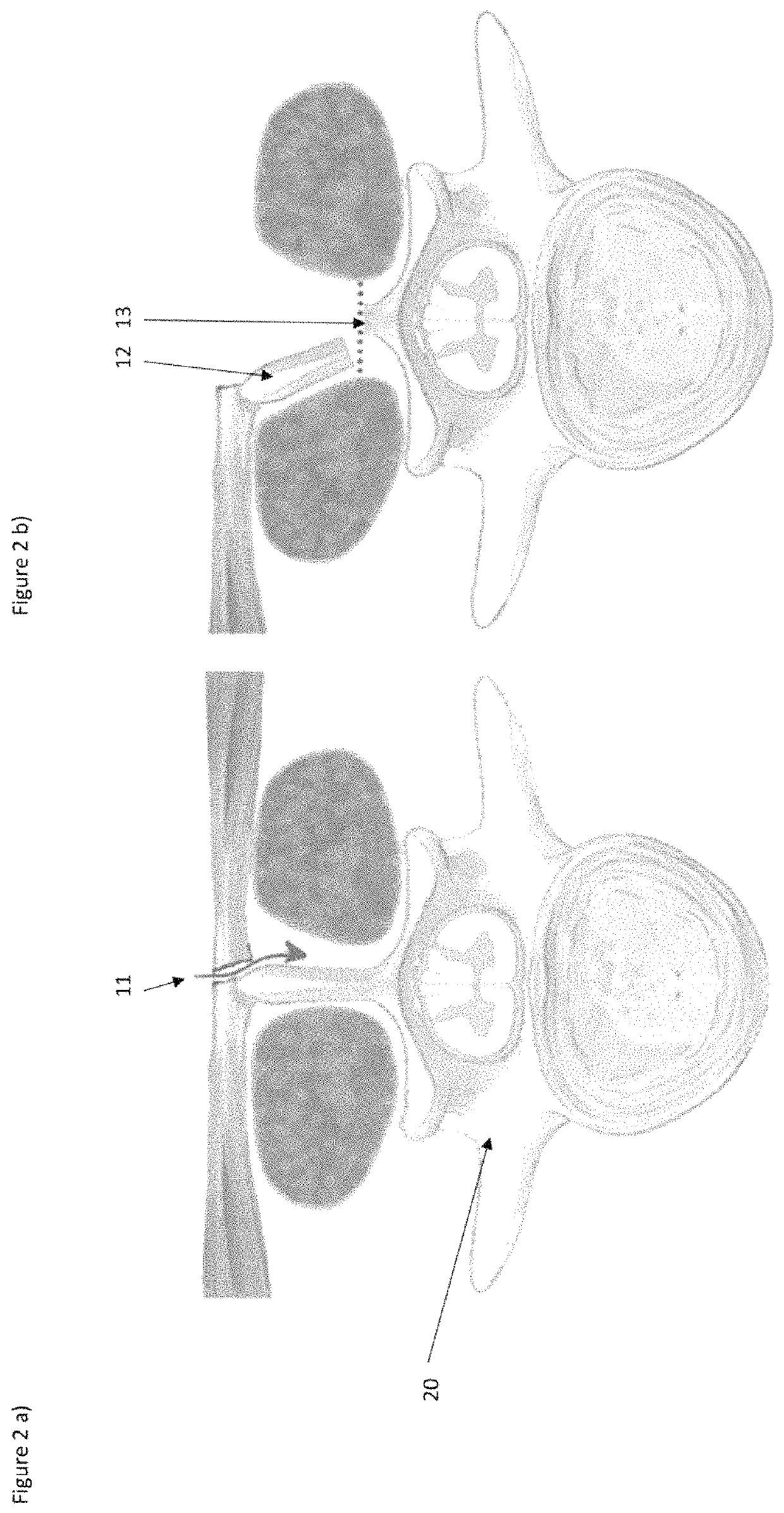 Surgical methods for the treatment of spinal stenosis