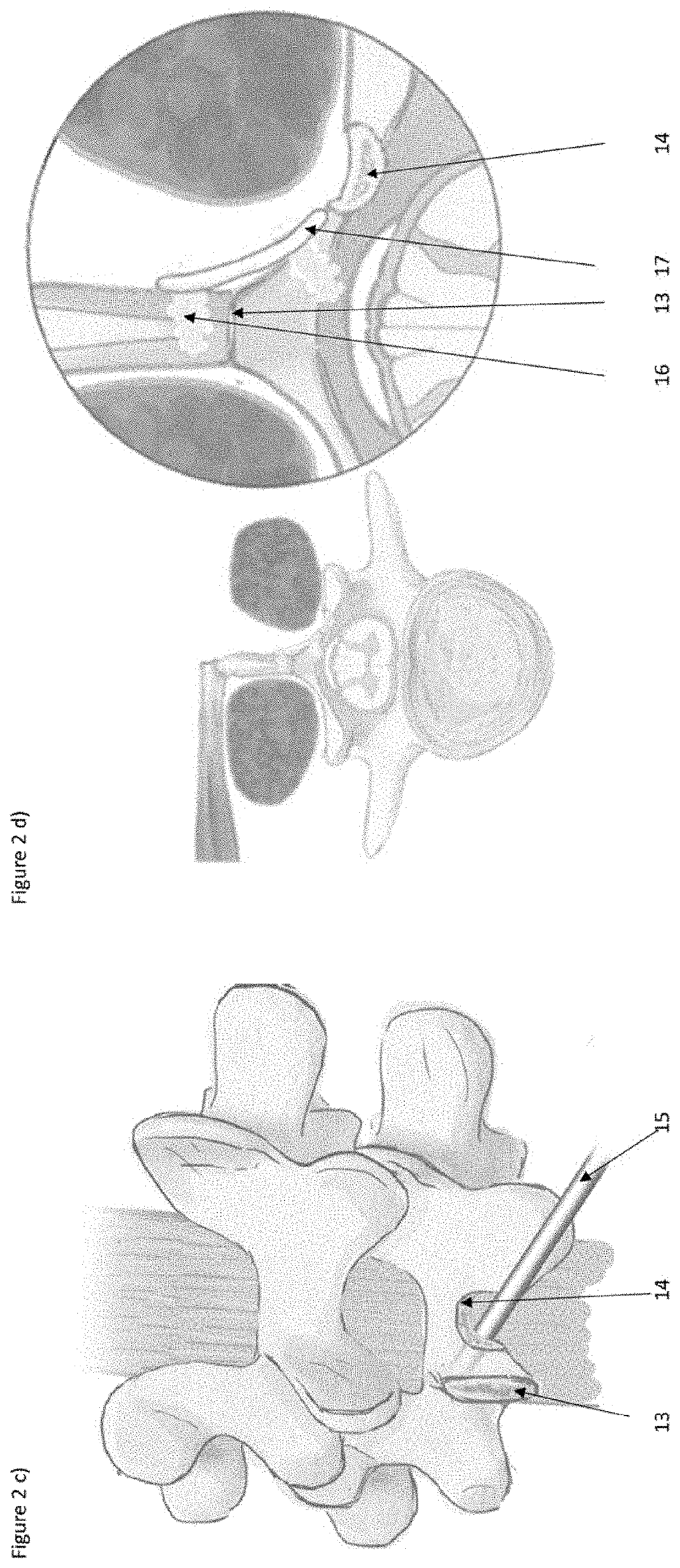 Surgical methods for the treatment of spinal stenosis