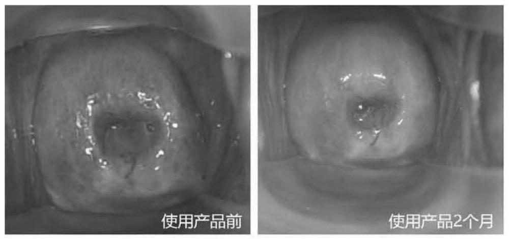 Gel for repairing cervical erosion and preparation method thereof