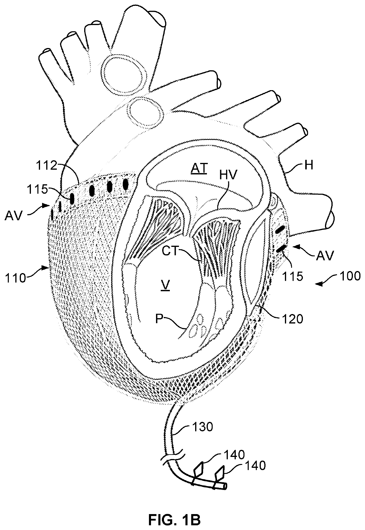 Cardiac treatment system and method