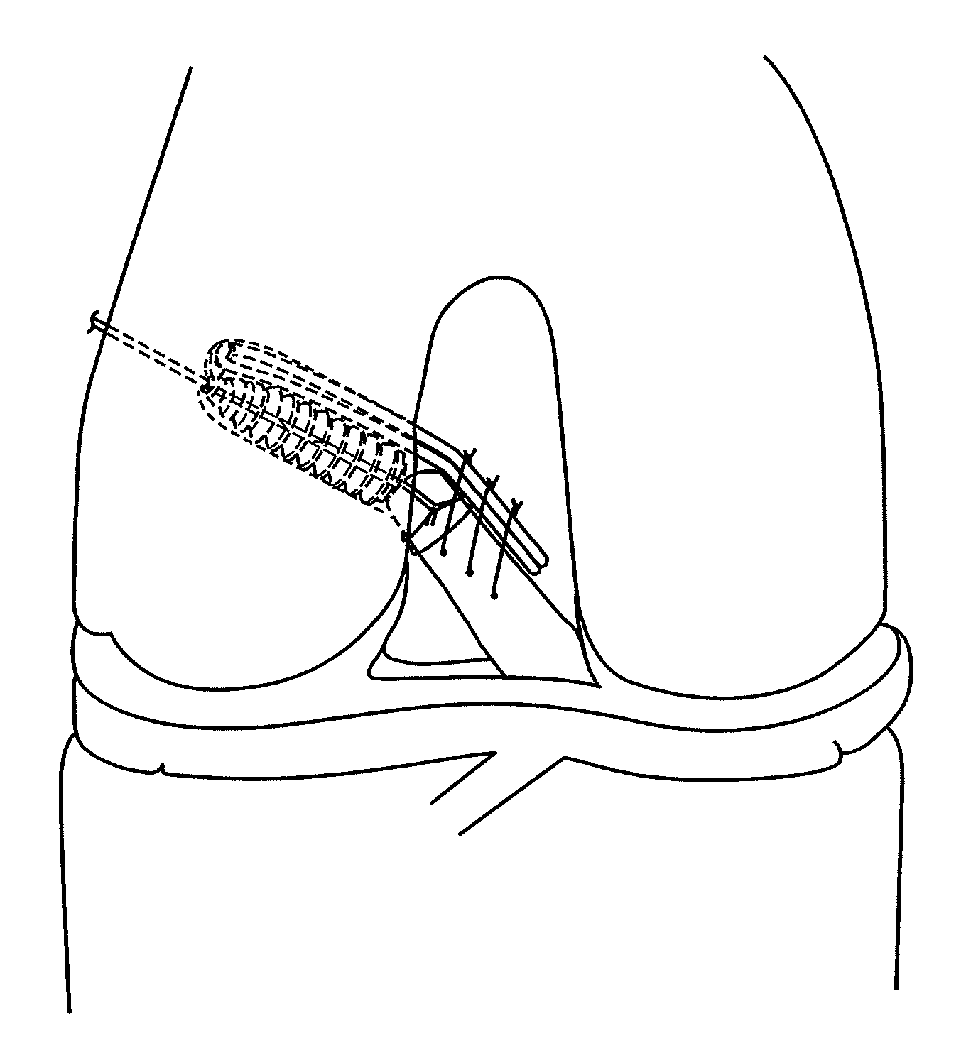 Implant and method for repair of the anterior cruciate ligament