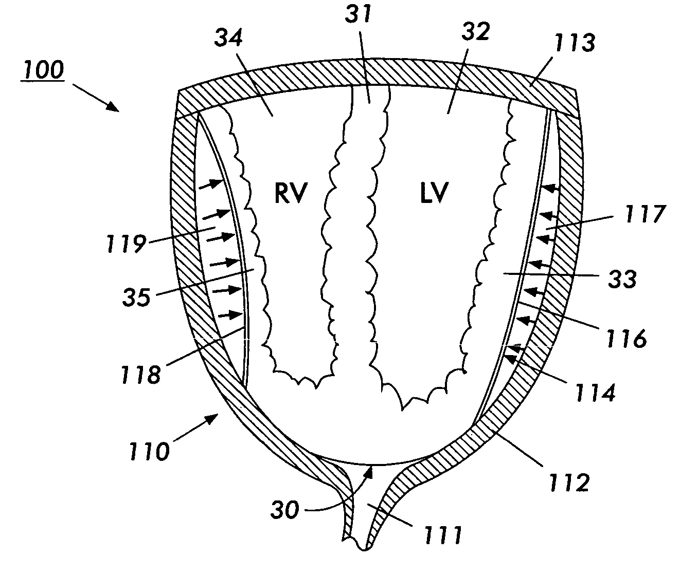 Therapeutic agent delivery apparatus with direct mechanical ventricular assistance capability