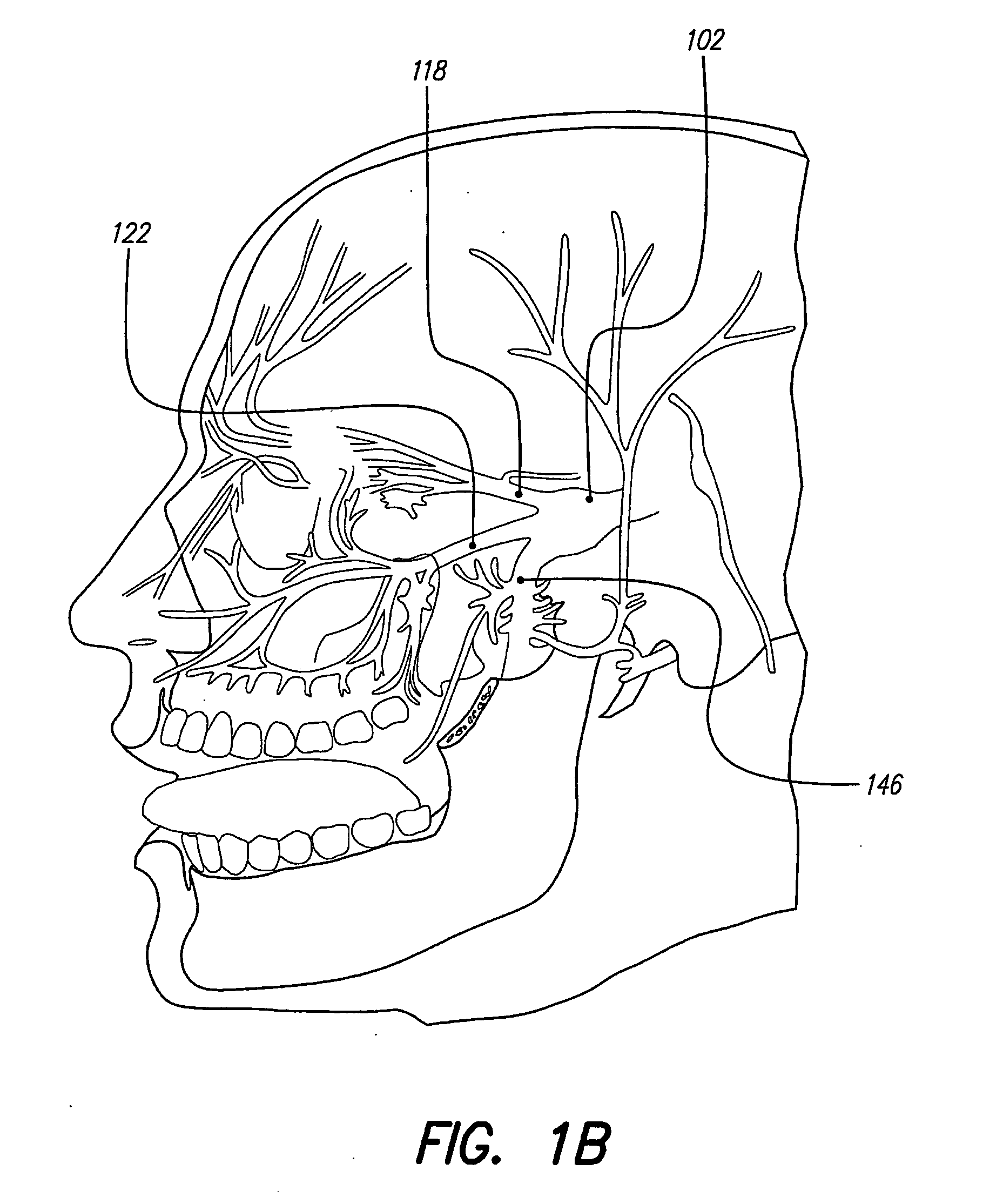 Skull-mounted electrical stimulation system and method for treating patients