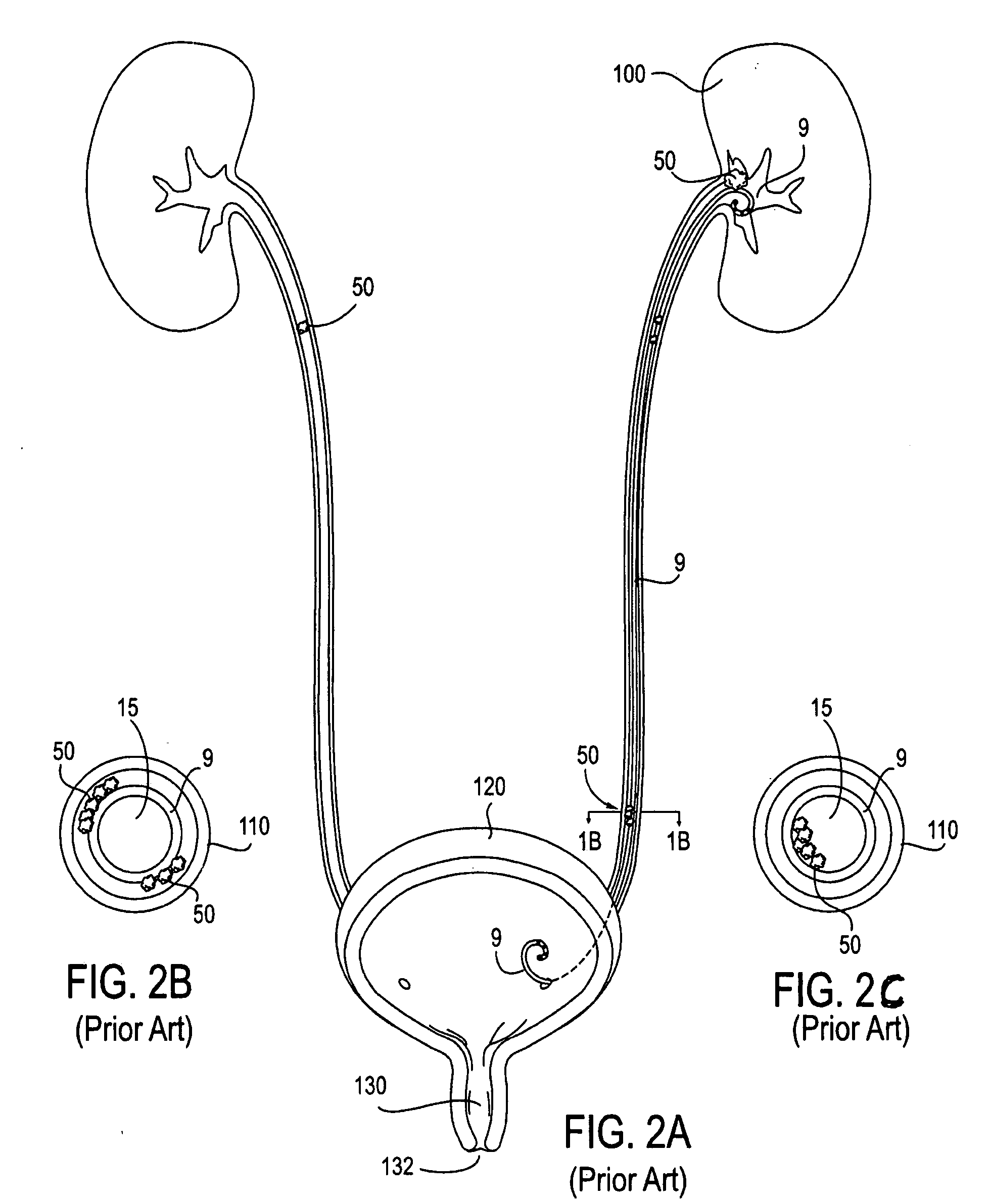 System and method to counter material deposition on devices in the urinary tract