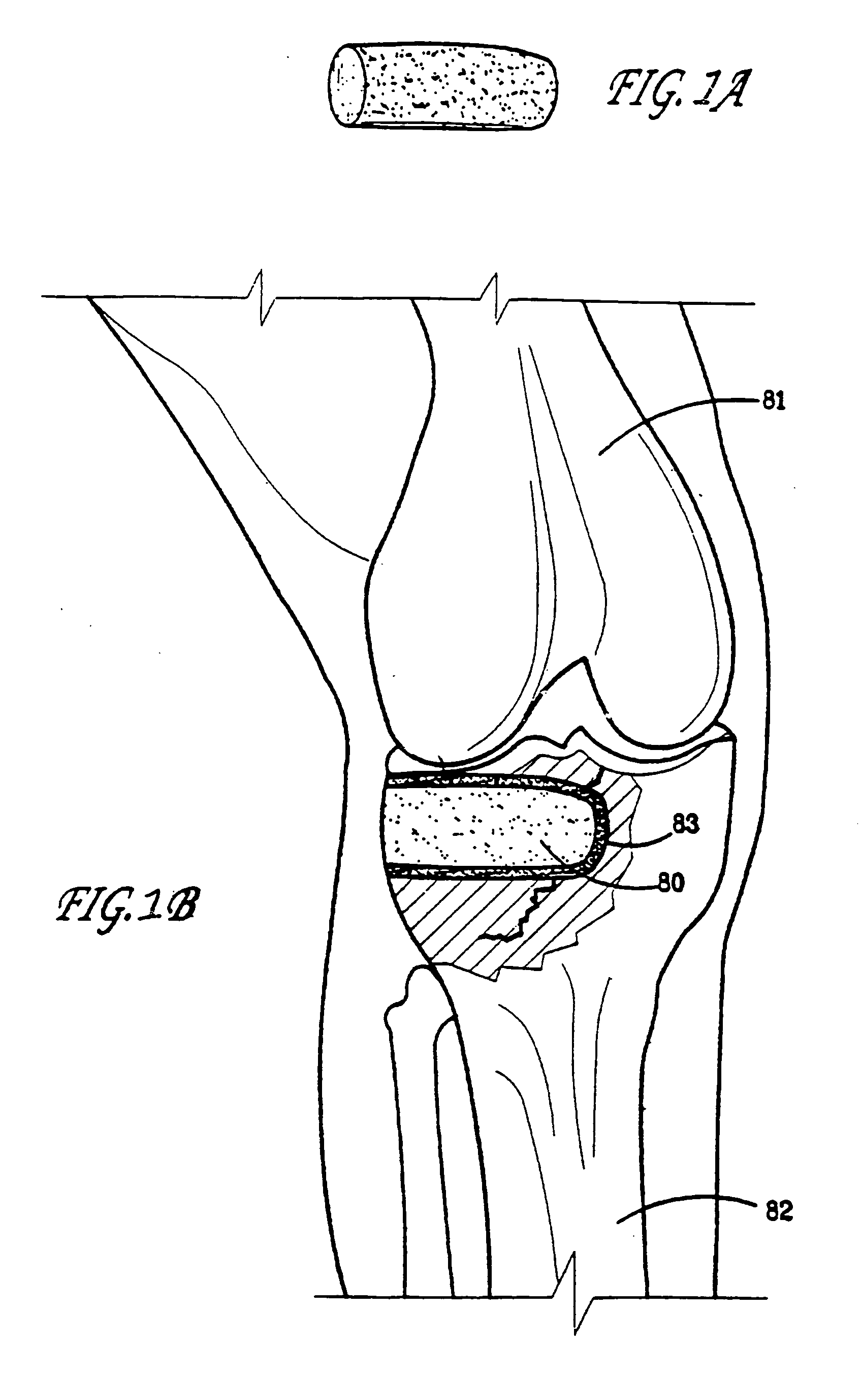 Bone restorative carrier mediums