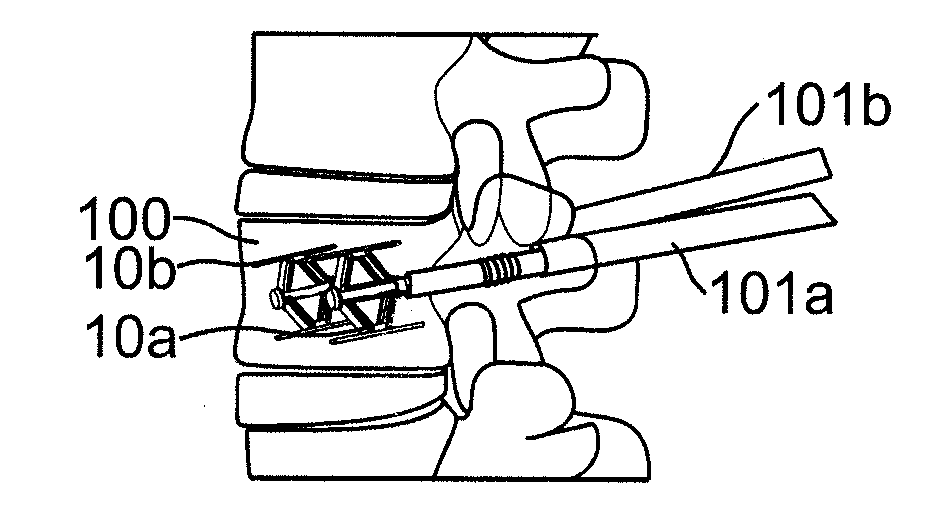 Apparatus for Bone Restoration of the Spine and Methods of Use