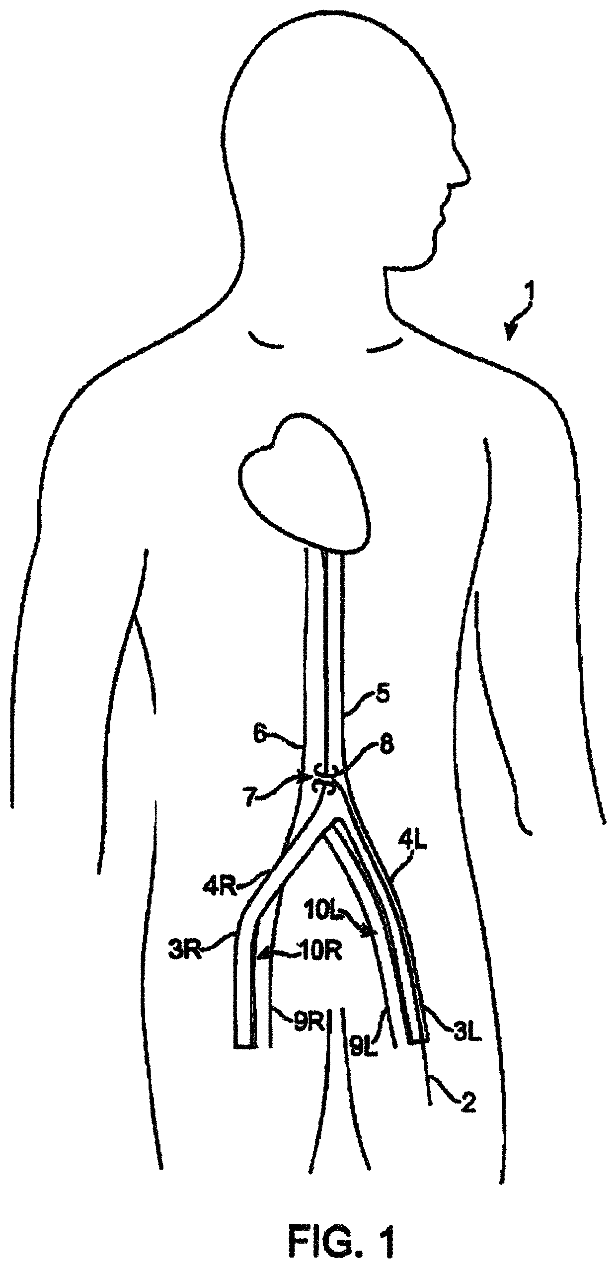 Device and method for establishing an artificial arterio-venous fistula