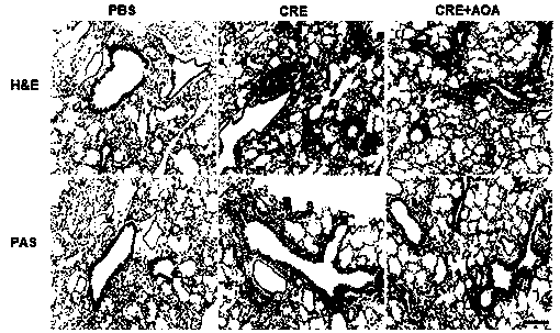 Use of small molecule compound aminoxyacetic acid in preparing medicine for treating asthma