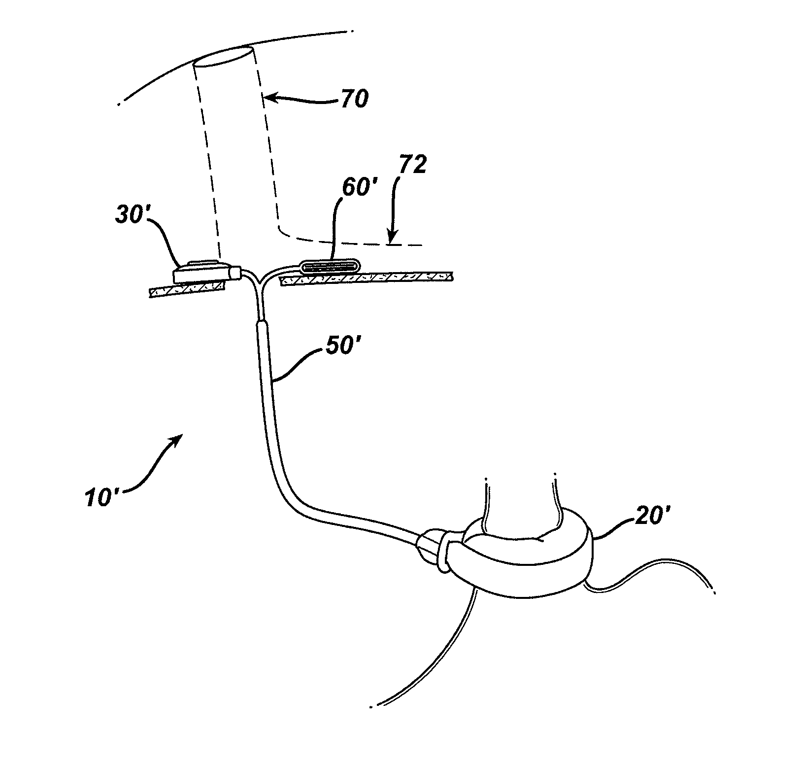 Methods for implanting a gastric restriction device
