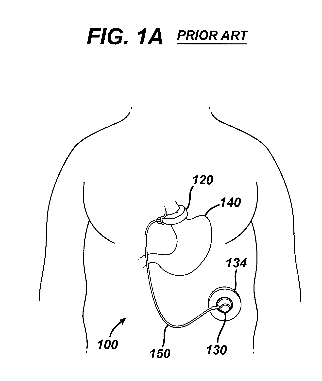 Methods for implanting a gastric restriction device