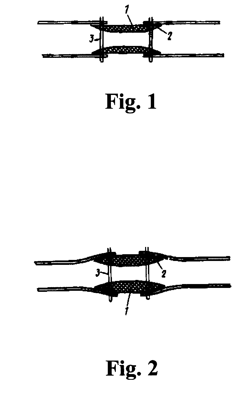 Method For Radical Removal of Parasagittal Meningioma