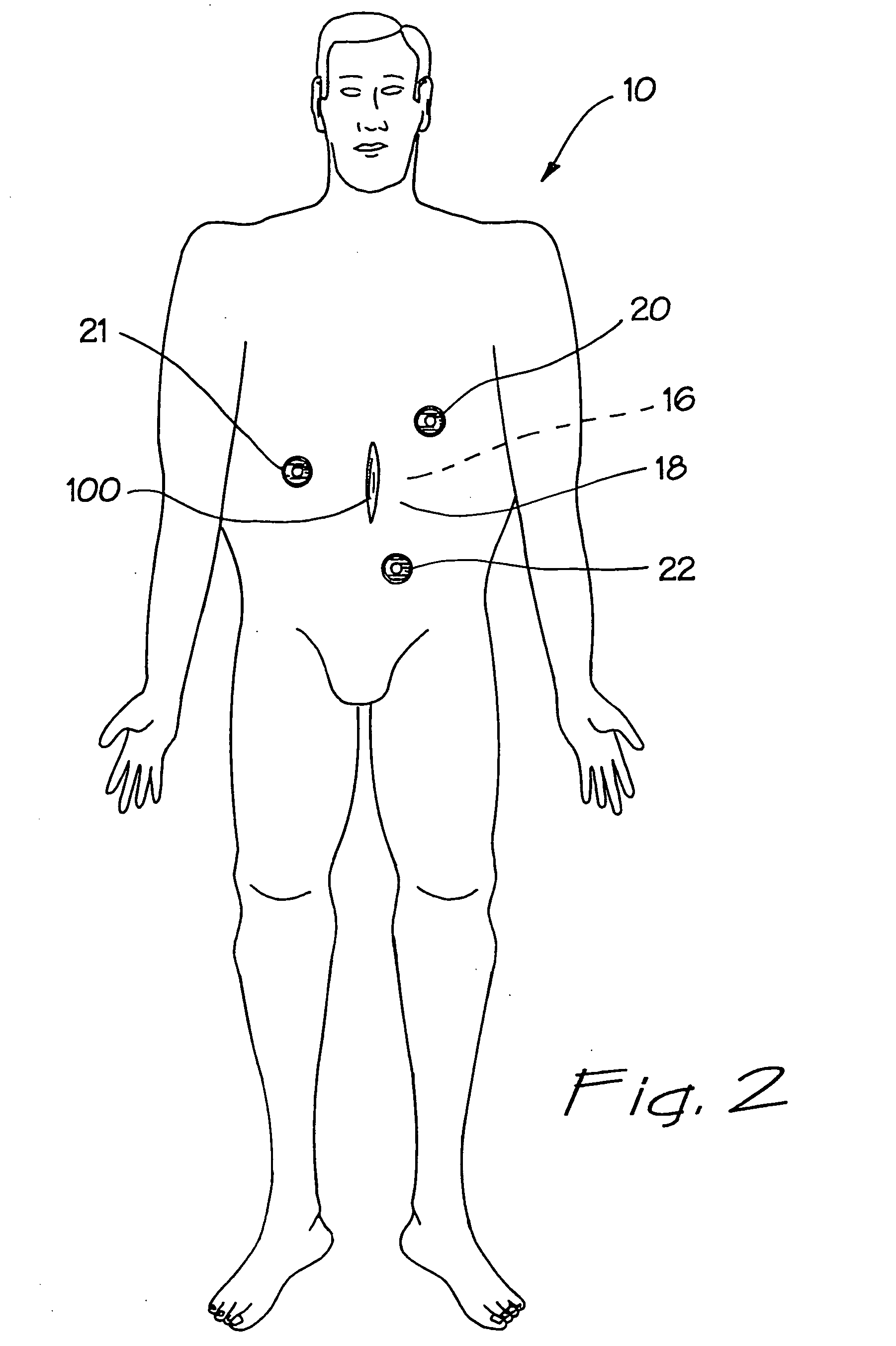 Sealed surgical access device