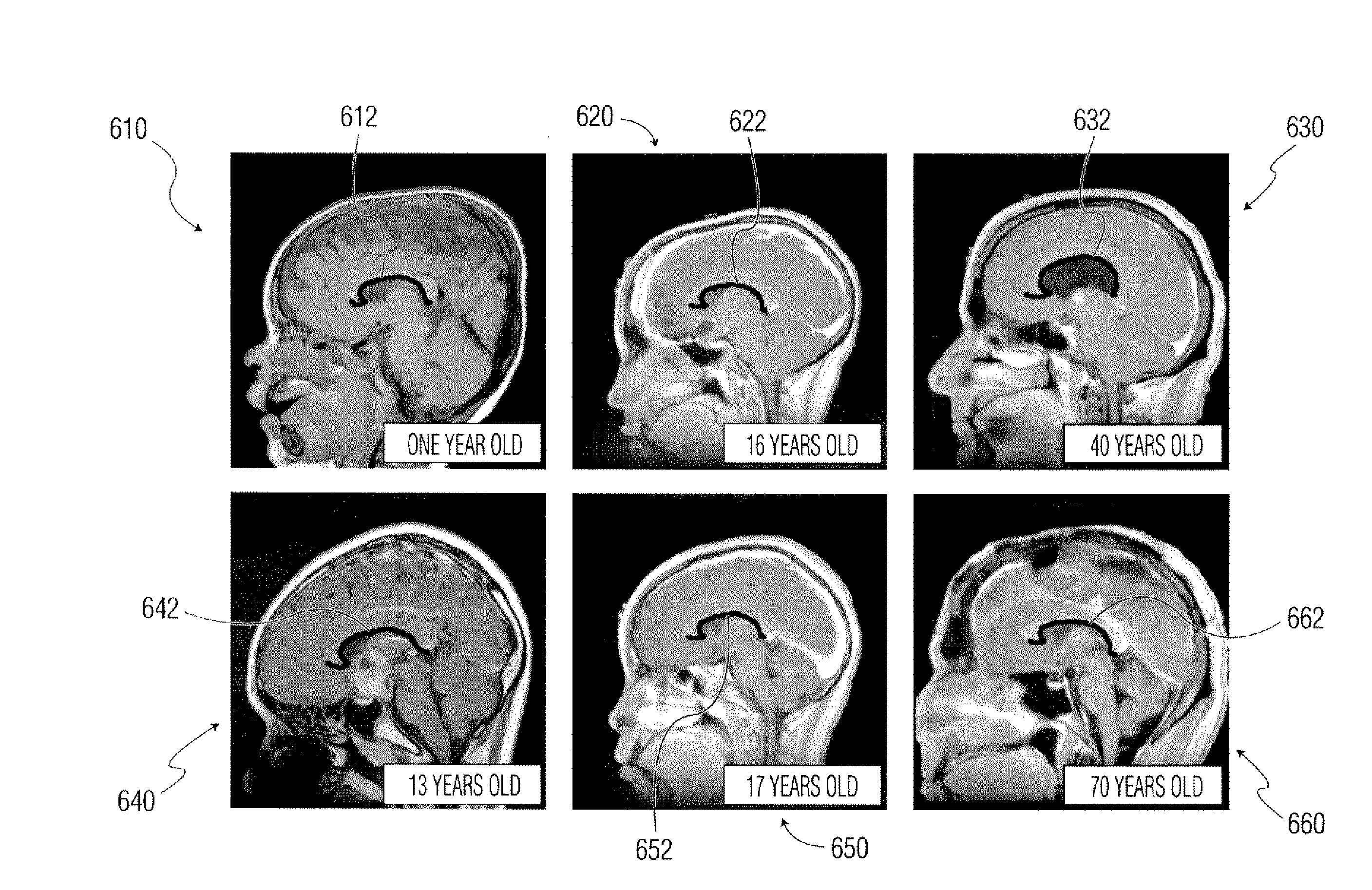 System and Method for Corpus Callosum Segmentation in Magnetic Resonance Images