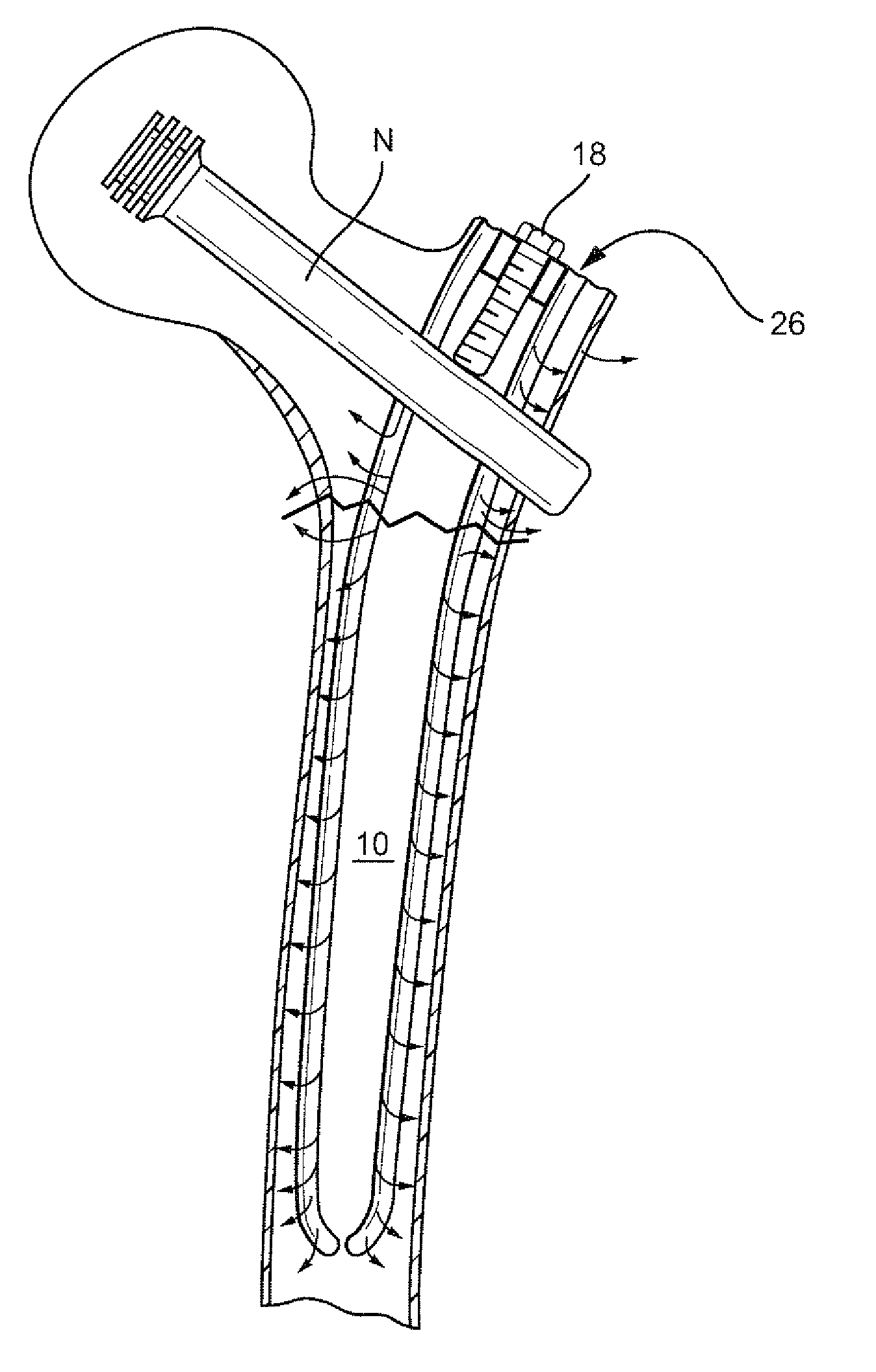 Biologic intramedullary fixation device and methods of use