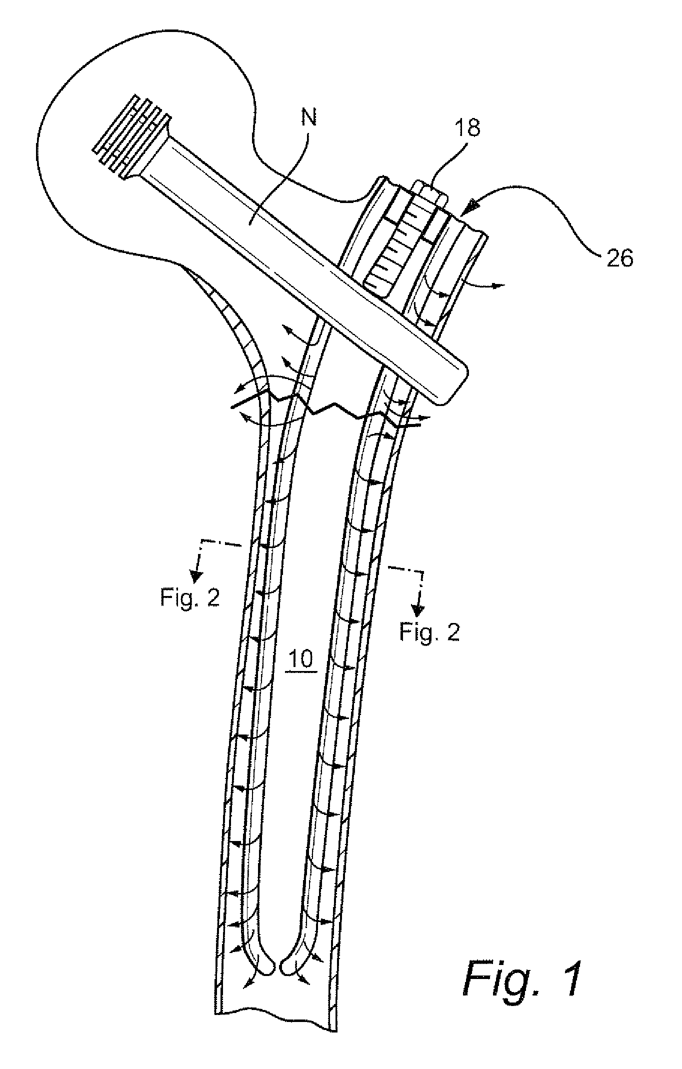 Biologic intramedullary fixation device and methods of use