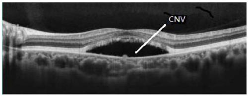 BEST1 novel mutation disease-causing gene for retinosis diseases and kit thereof