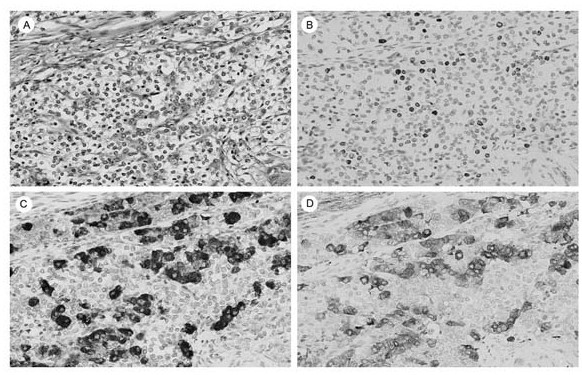Application of insulinoma-related protein 1 as marker for diagnosing or prognostically evaluating prostate neuroendocrine small cell carcinoma