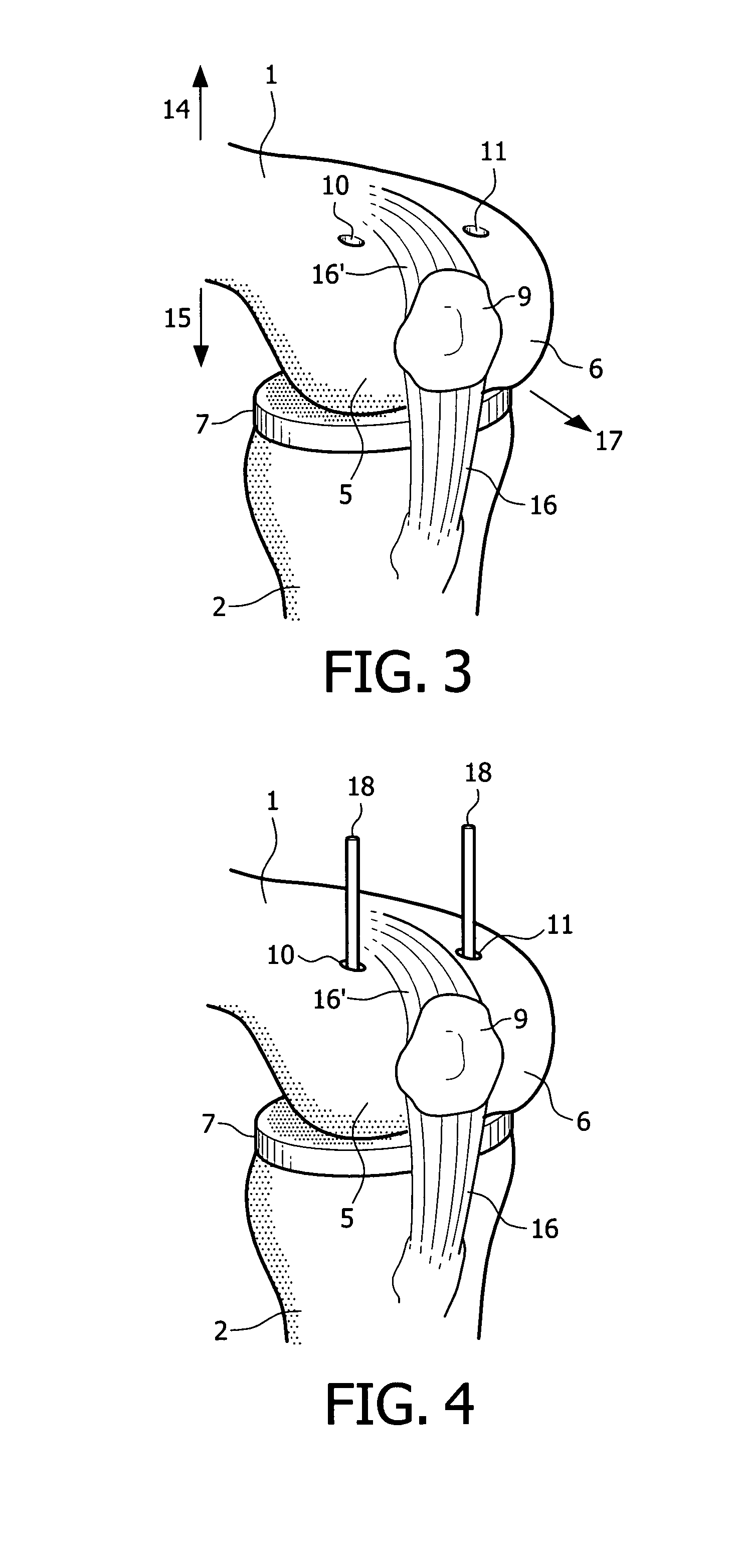 Device and method for installing femoral prosthetic knee joint