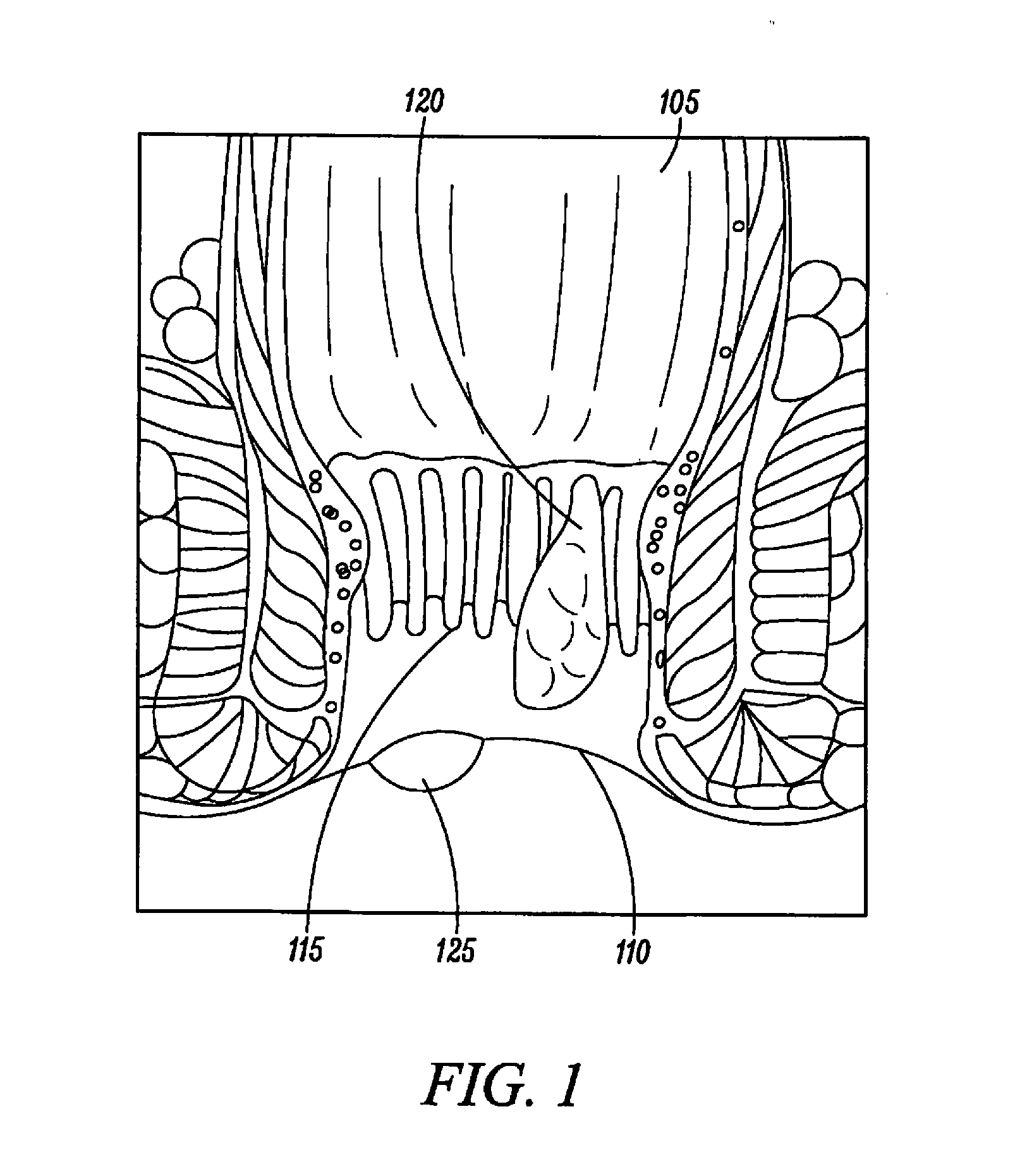 Gentle hemorrhoid treatment offering a substantially painless healing