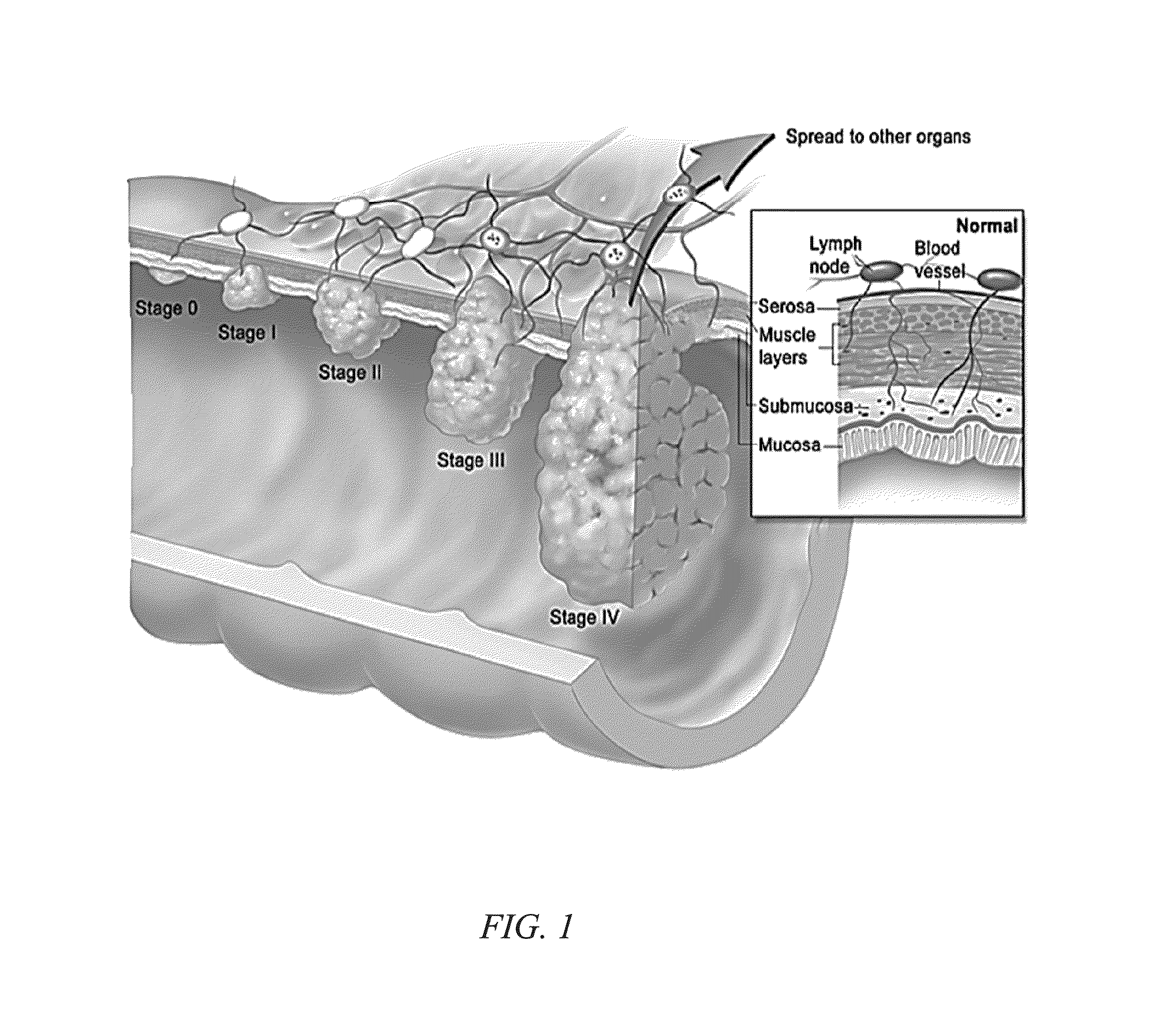 Method of screening for colon cancer using biomarkers