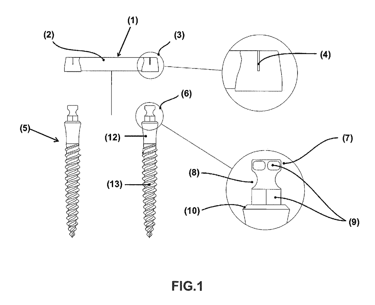 Prosthetic retention system for edentulous patients consisting of a prefabricated bar and two implants