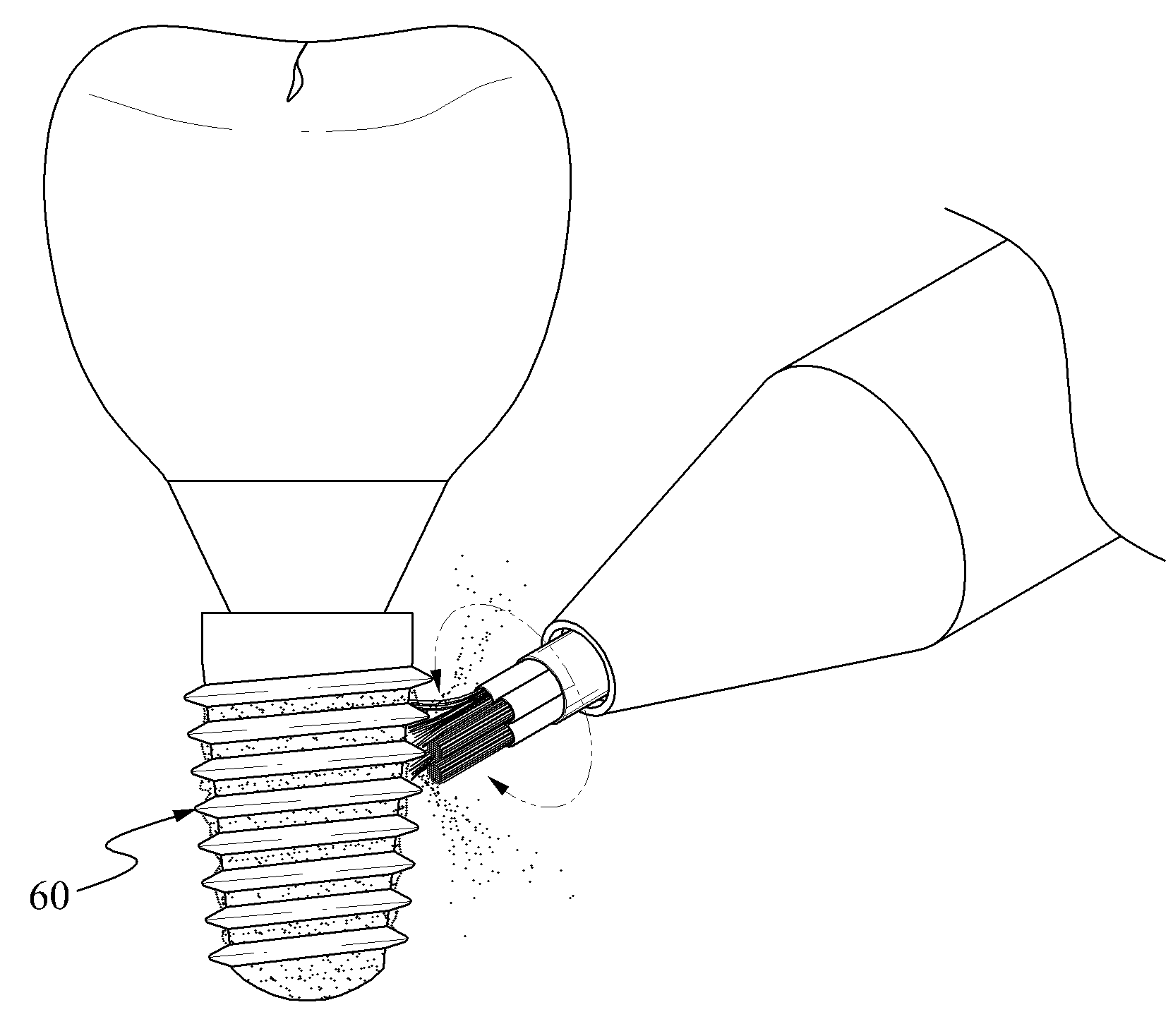 Infected dental implant cleaning technique