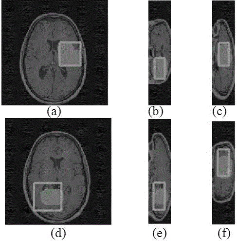 3D automatic glioma segmentation method combining Volume of Interest and GrowCut algorithm