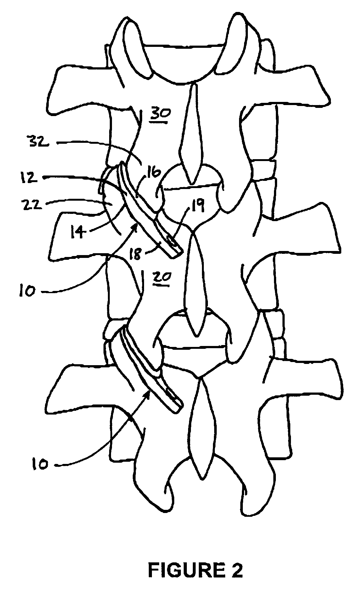 Method and device for treating scoliosis