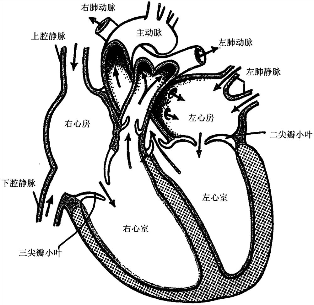 Combined self-expanding inferior vena cava stent