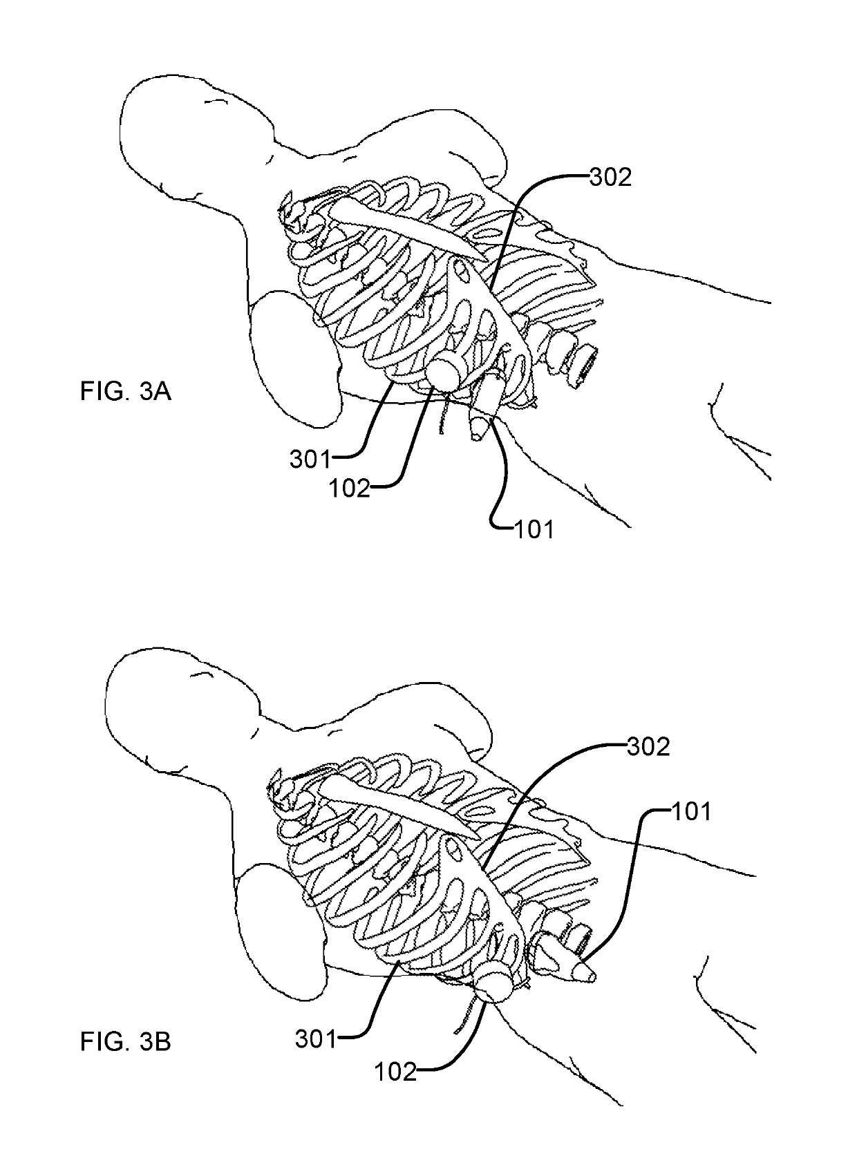 Ultrasound shear wave vibro-elastography of the abdomen