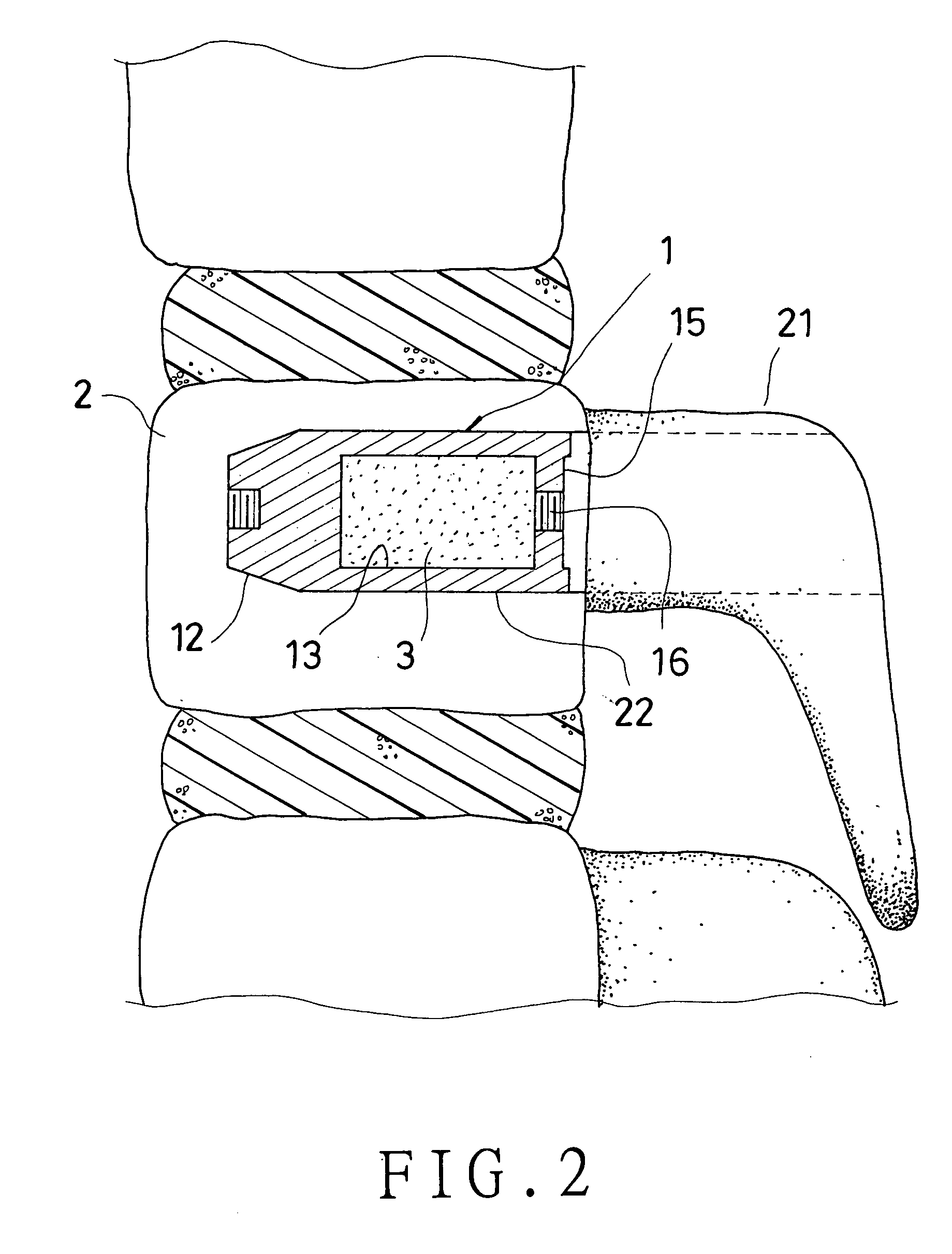 Body augmenter capable of being planted through a pedicle for vertebral body reconstruction