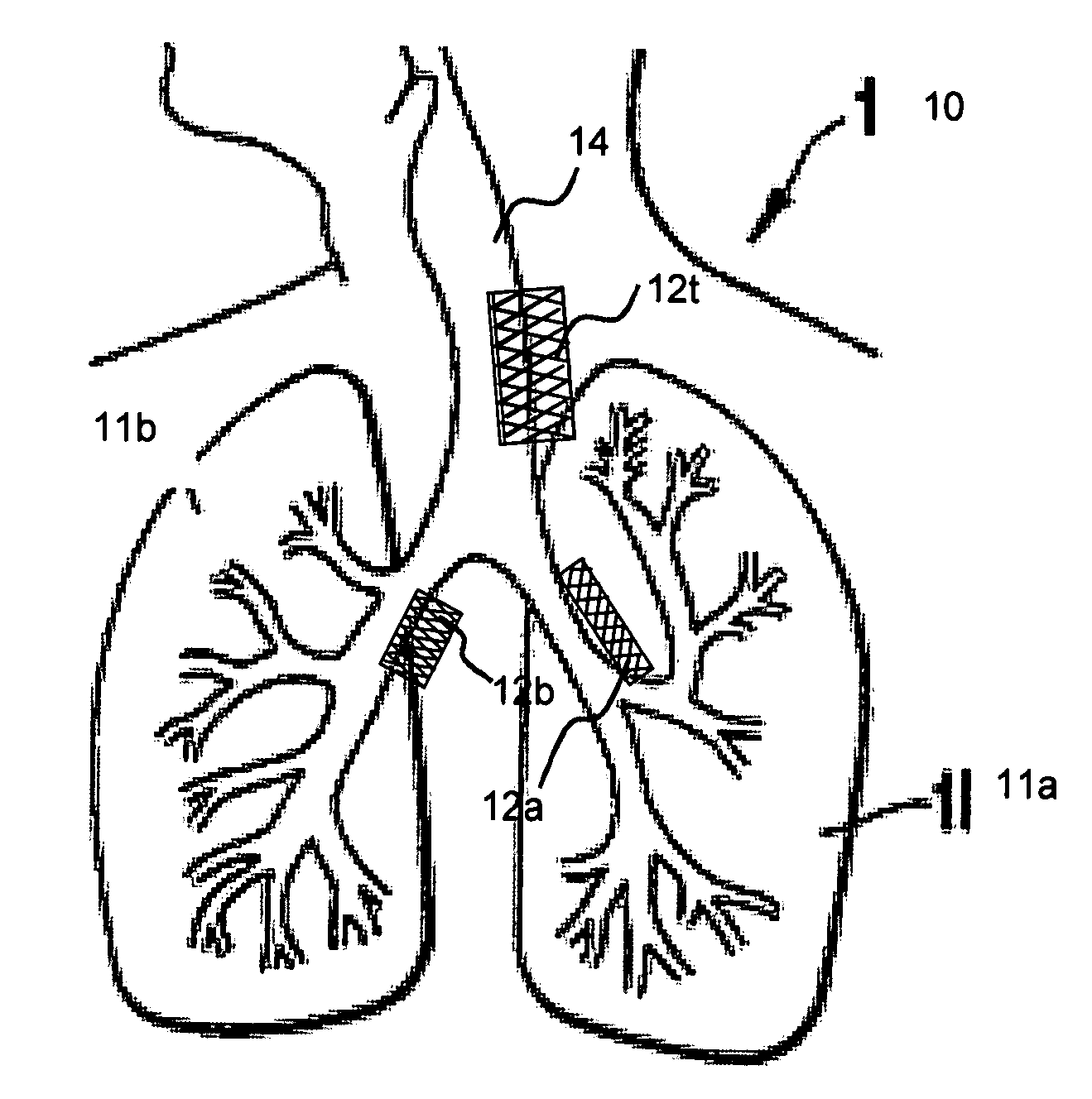 Therapeutic agent delivery for the treatment of asthma via implantable and insertable medical devices