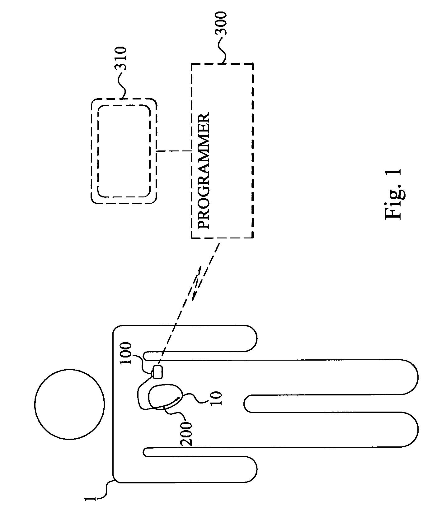 Method and device for monitoring acute decompensated heart failure