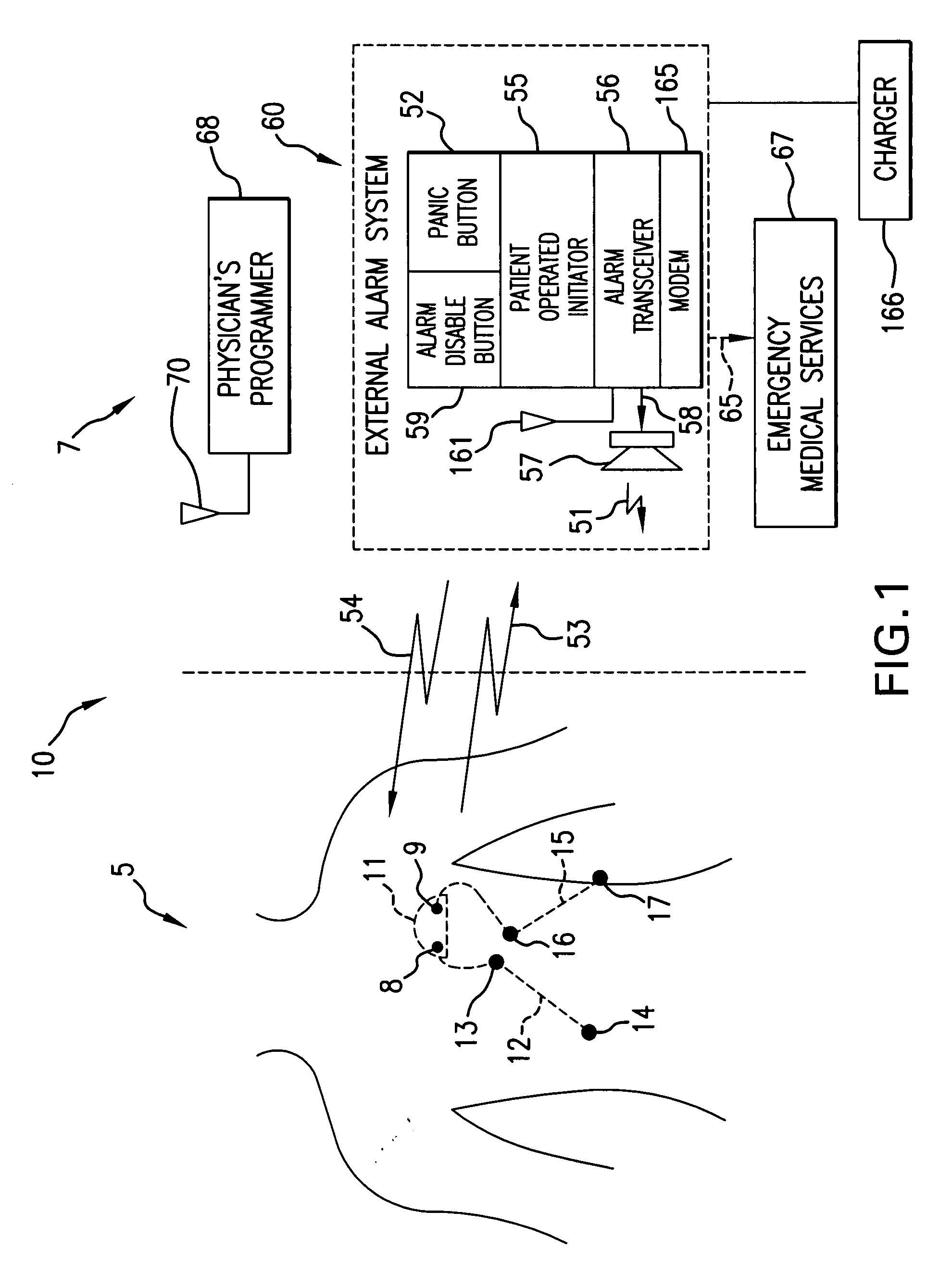 System and methods for detecting ischemia with a limited extracardiac lead set