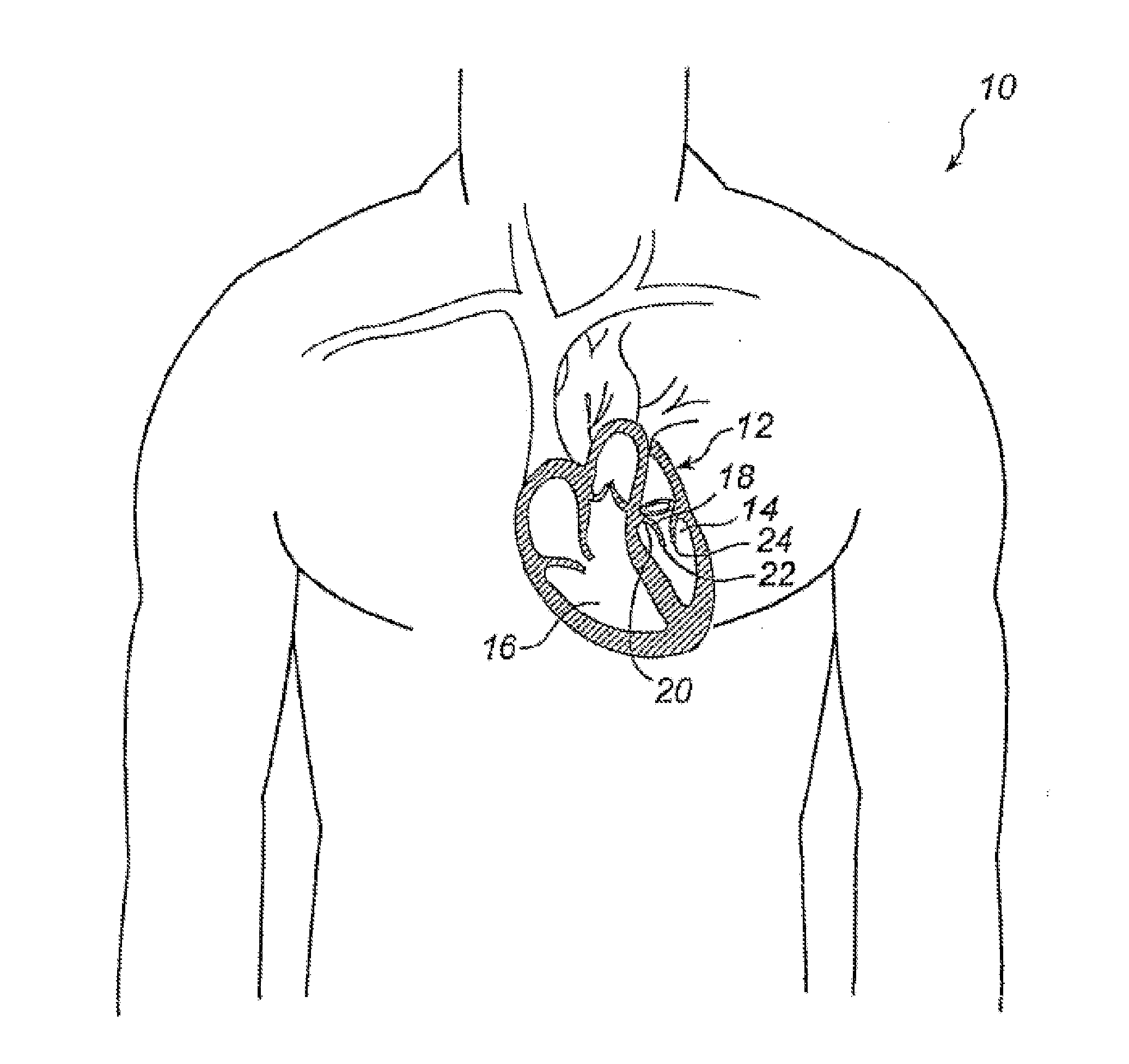 Device and Method For Improving Function Of Heart Valve