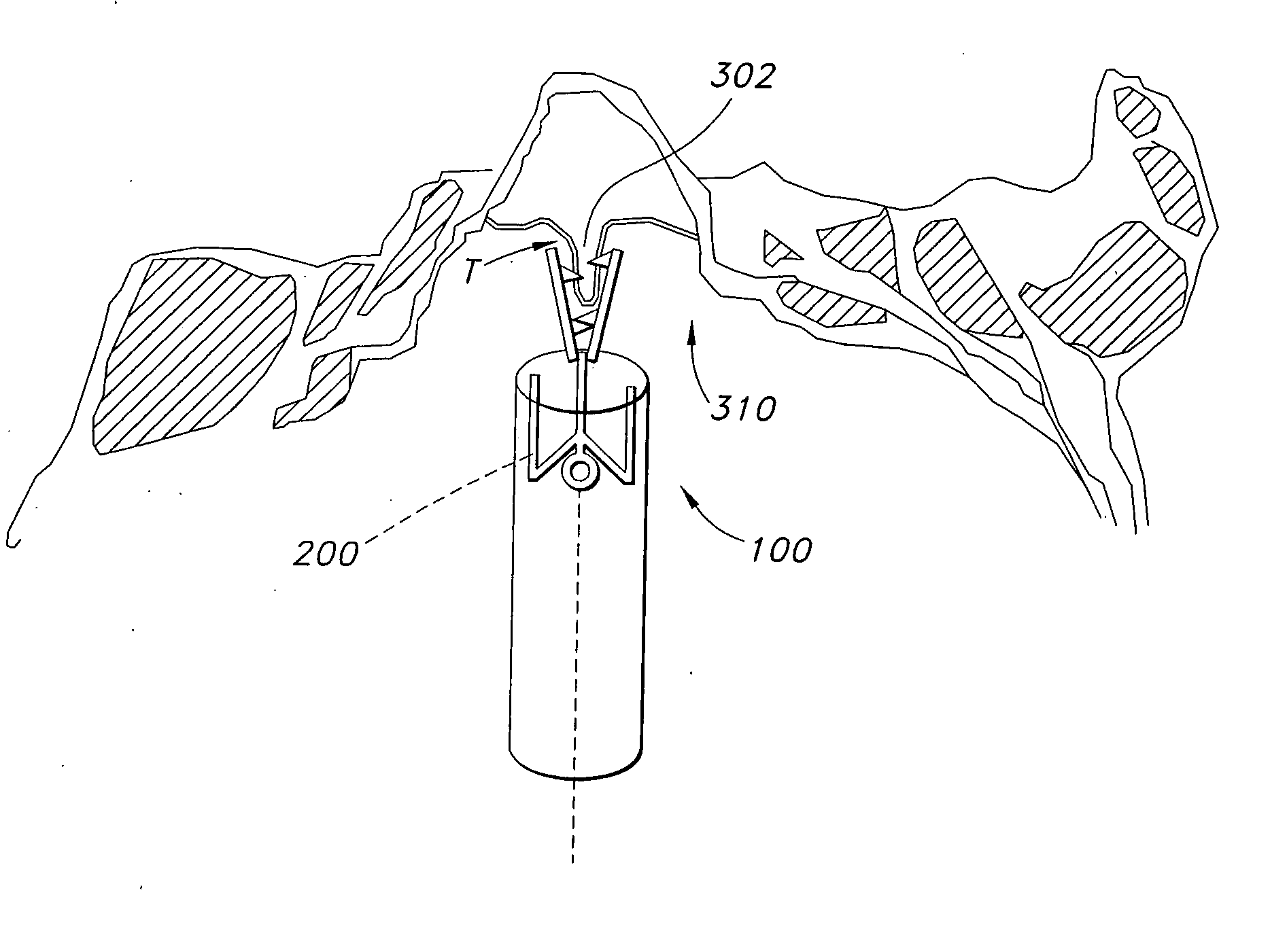 Devices and methods for treating mitral valve regurgitation