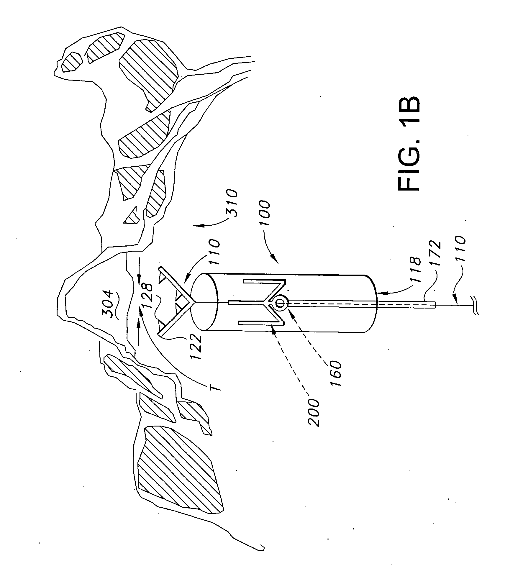 Devices and methods for treating mitral valve regurgitation
