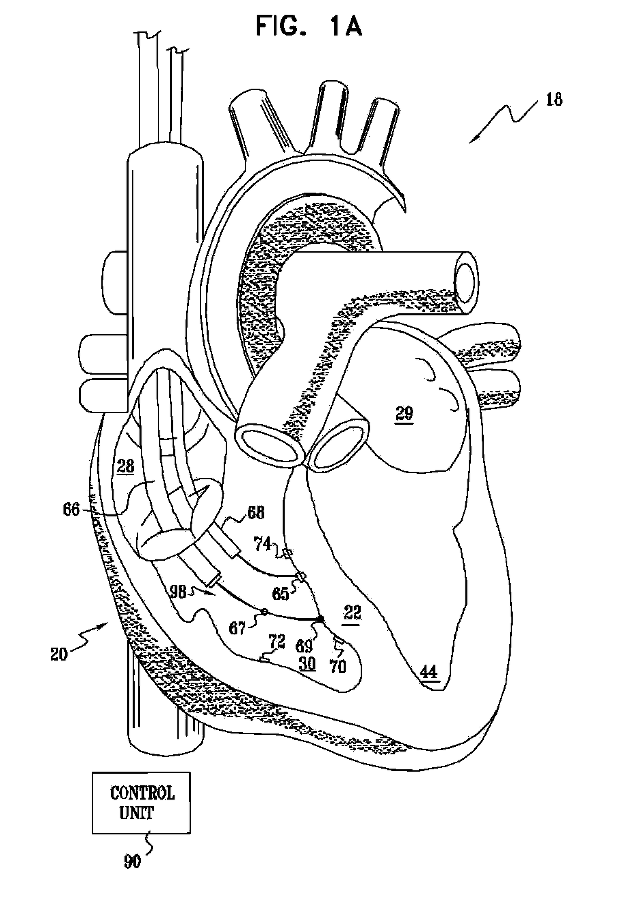 Signal delivery through the right ventricular septum