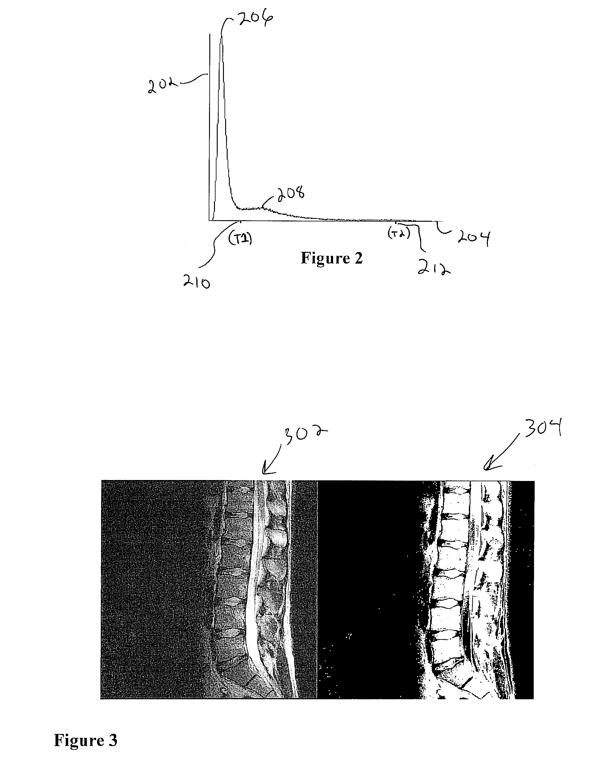 Method and system for vertebrae and intervertebral disc localization in magnetic resonance images