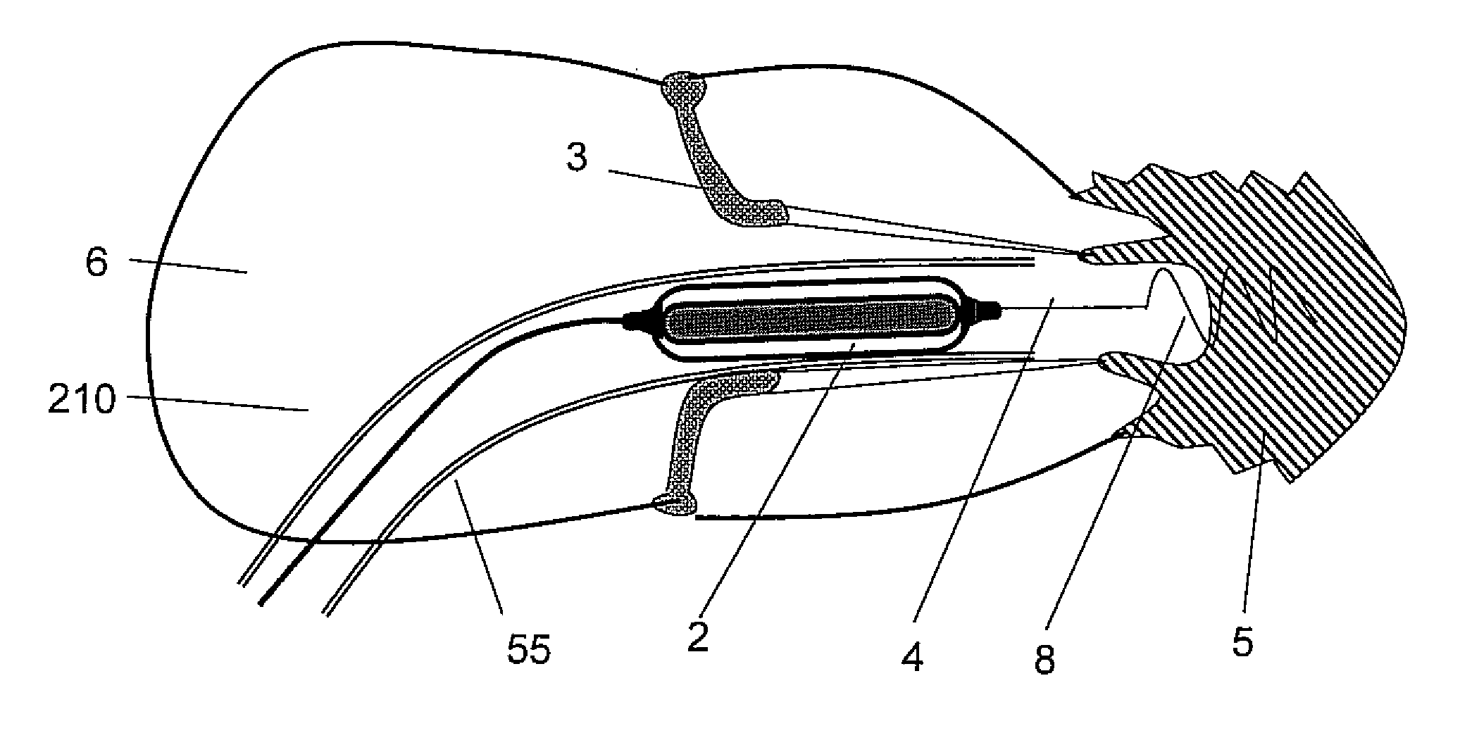 Medical device for use in treatment of a valve