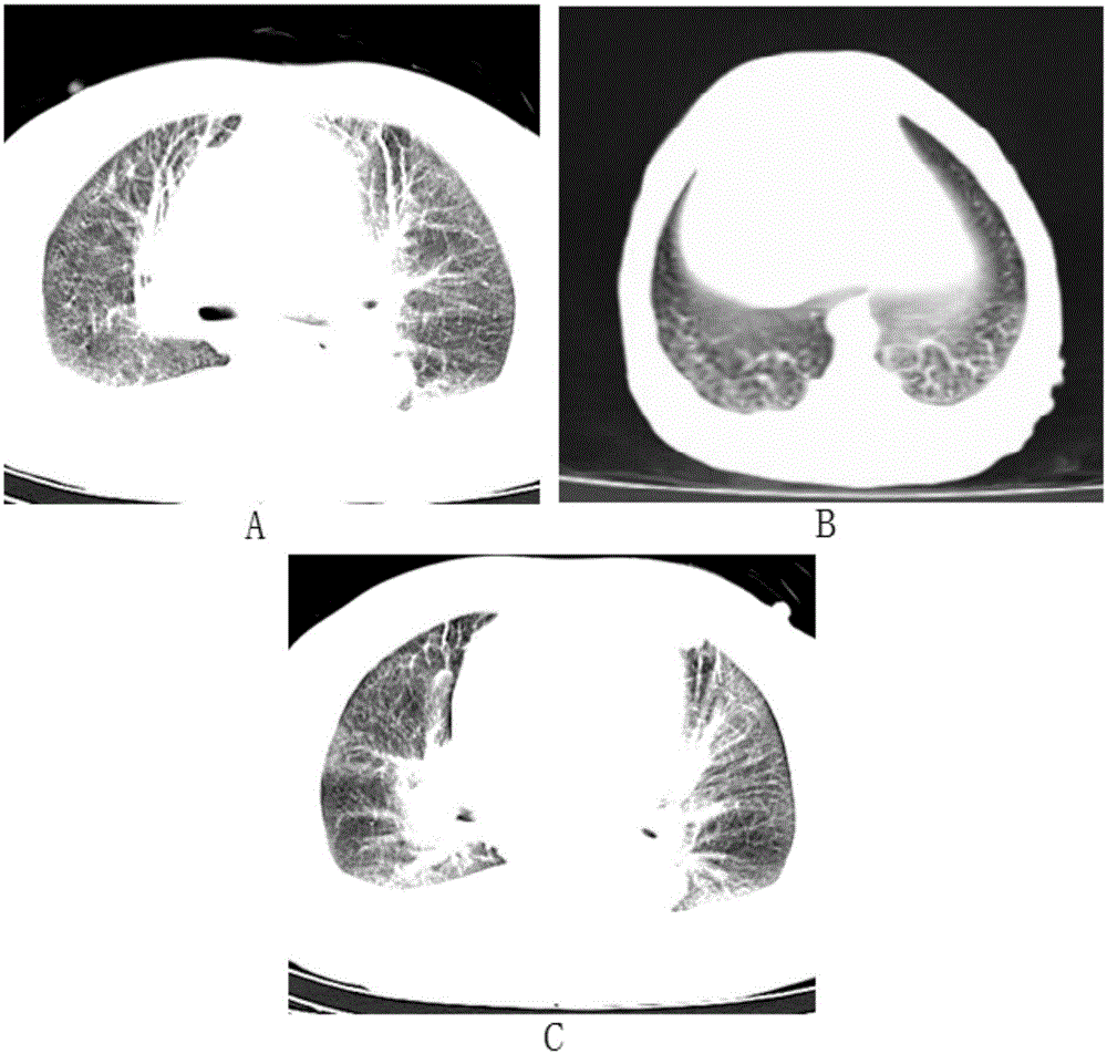Establishment and application of rhesus monkey pulmonary fibrosis model