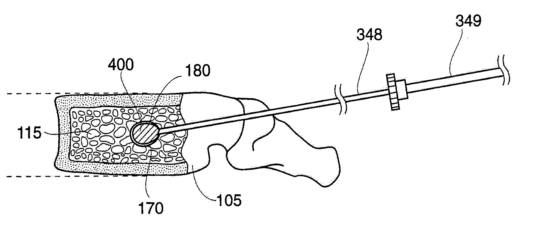 Methods and devices for treating fractured and/or diseased bone