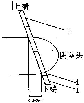 Inclined circular foreskin resistance complex ring